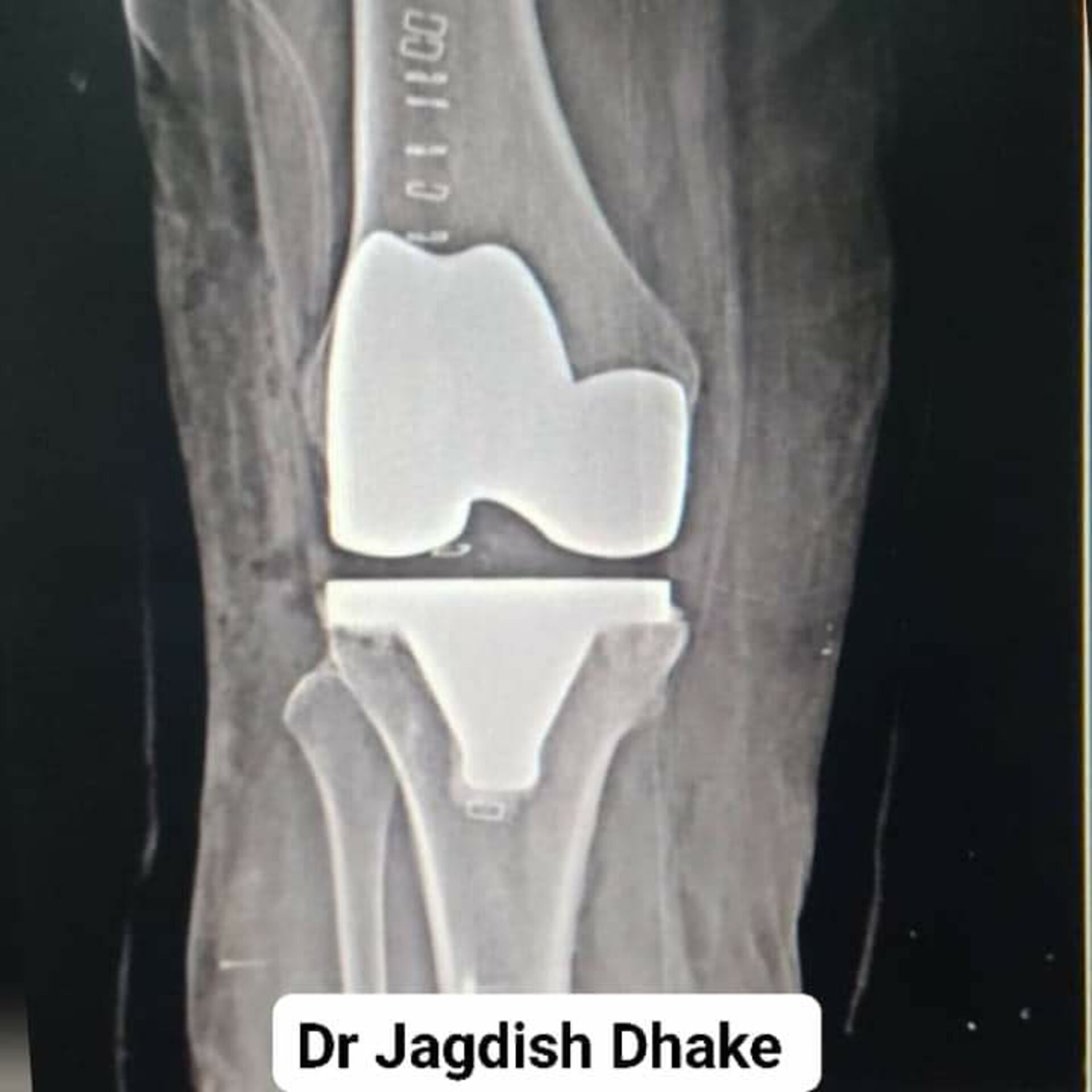 Treatment for Osteoarthritis by Dr. Jagdish Dhake | Knee replacement surgeon Pune