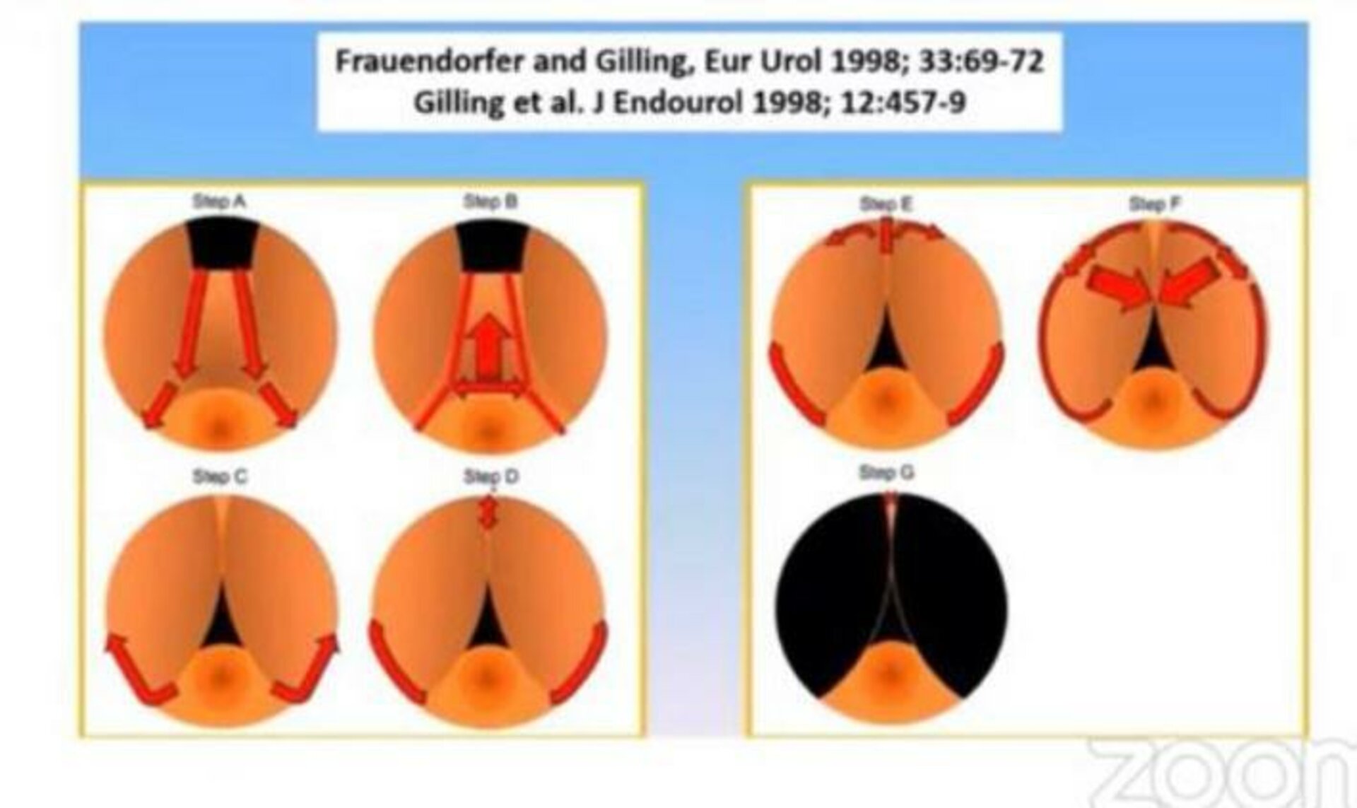 Urine Retention Post Angioplasty treated by Thulium laser Enucleation of Prostate | Dr. Bhoopat Bhati