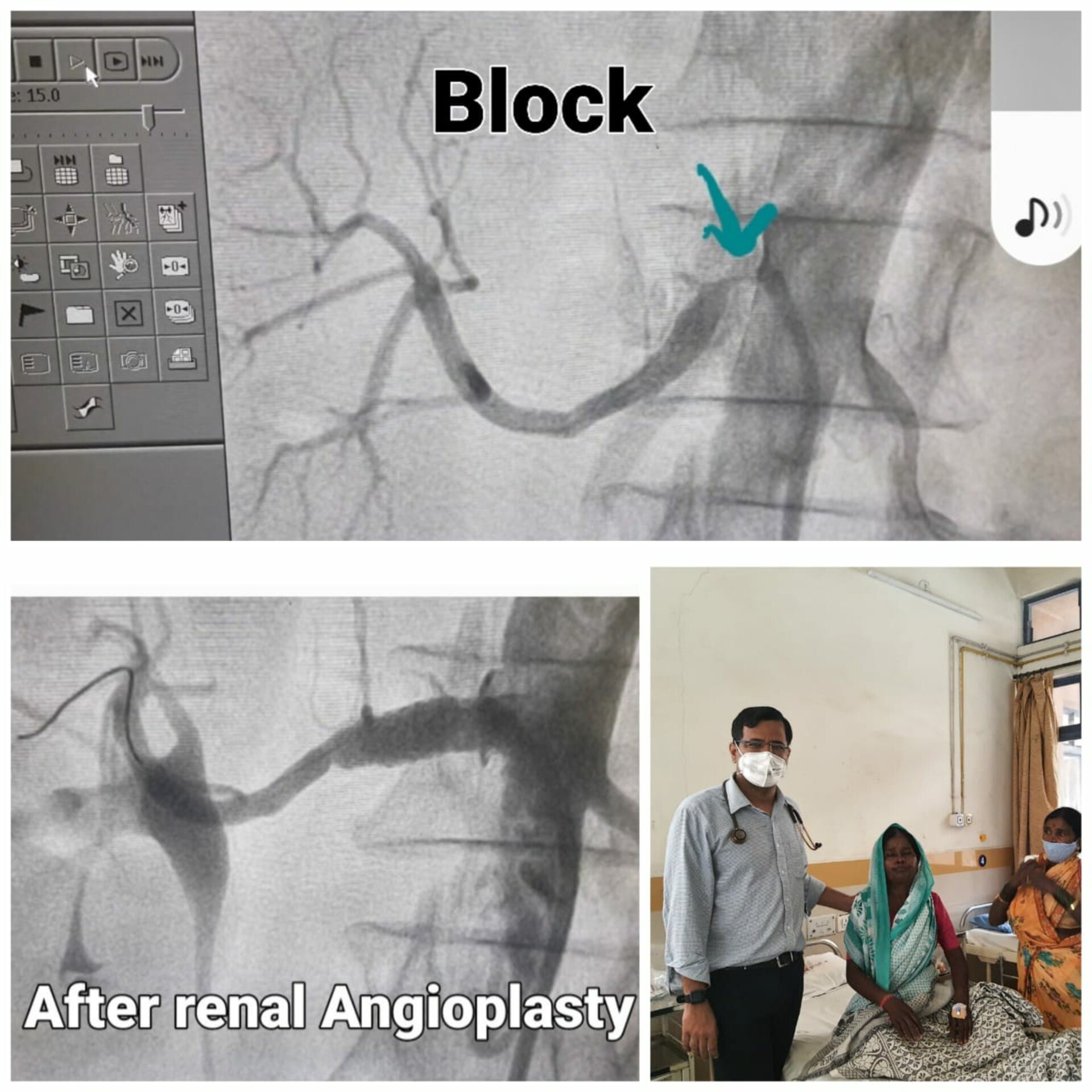 Sometimes need a Stent for the Hypertension