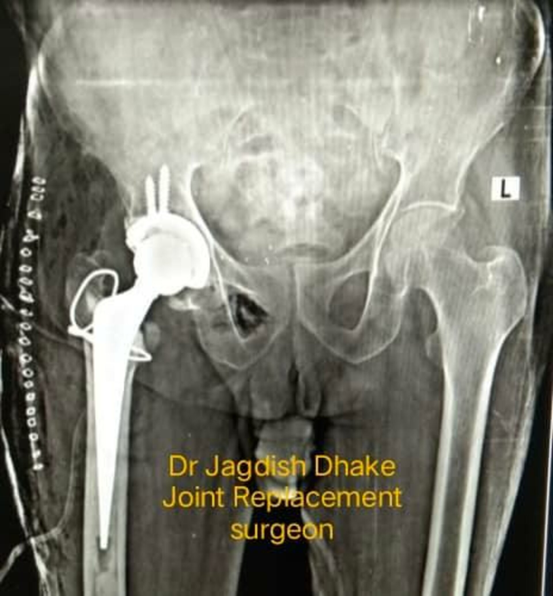 Hybrid total hip replacement | Dr. Jagdish Dhake