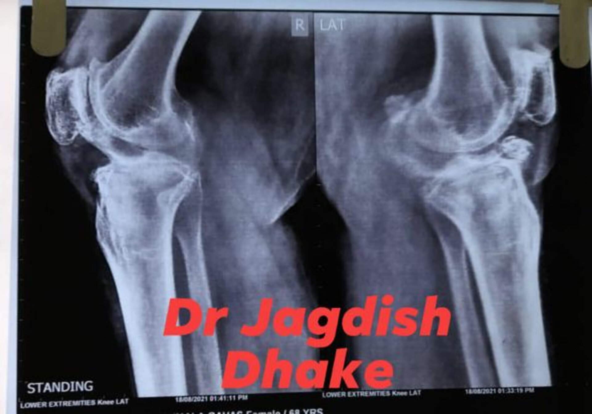 Total Knee Replacement - Dr. Jadish Dhake
