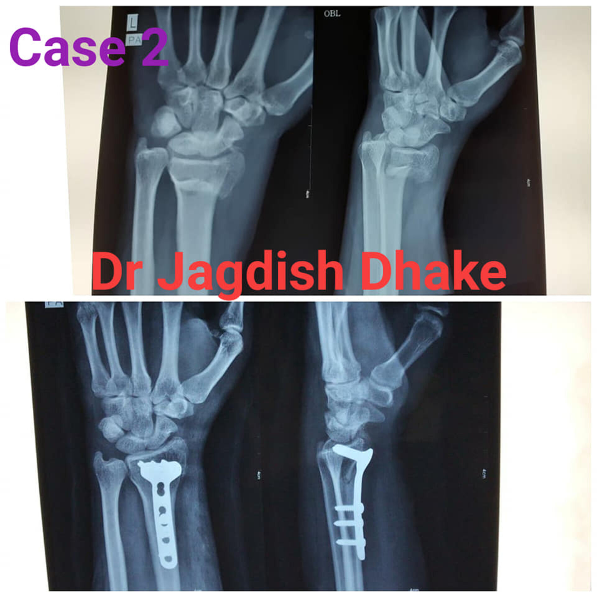 Cases handled by Dr. Jagdish Dhake - Orthopedic Surgeon