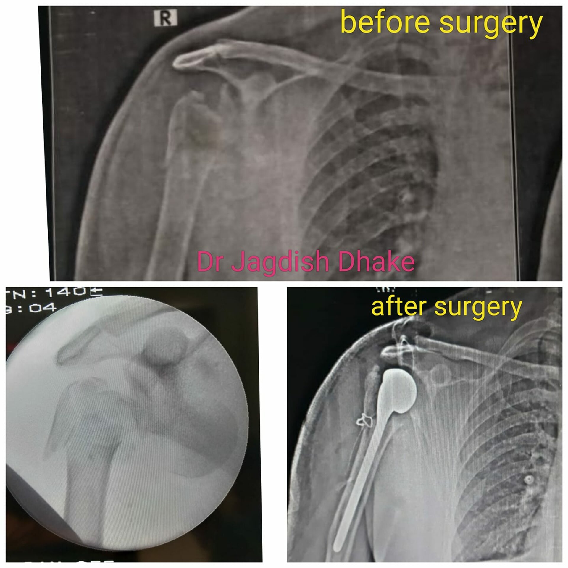 Fracture Dislocation Right Shoulder - Dr. Jagdish Dhake | Orthopedic Surgeon