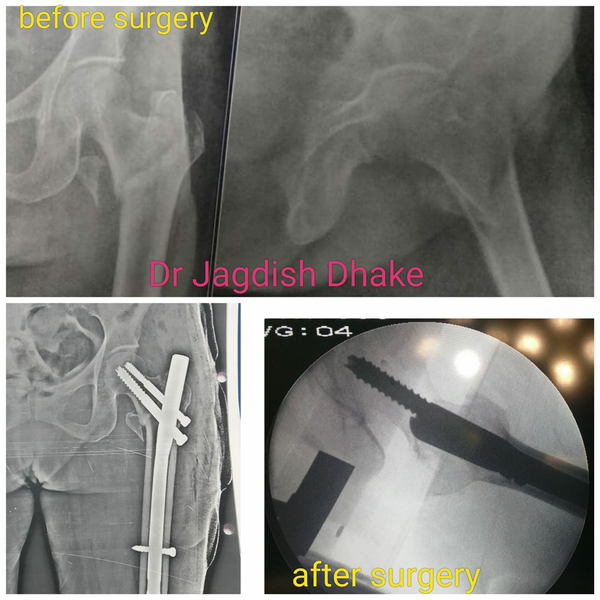 Intertrochanteric Fracture Femur | Dr. Jagdish Dhake