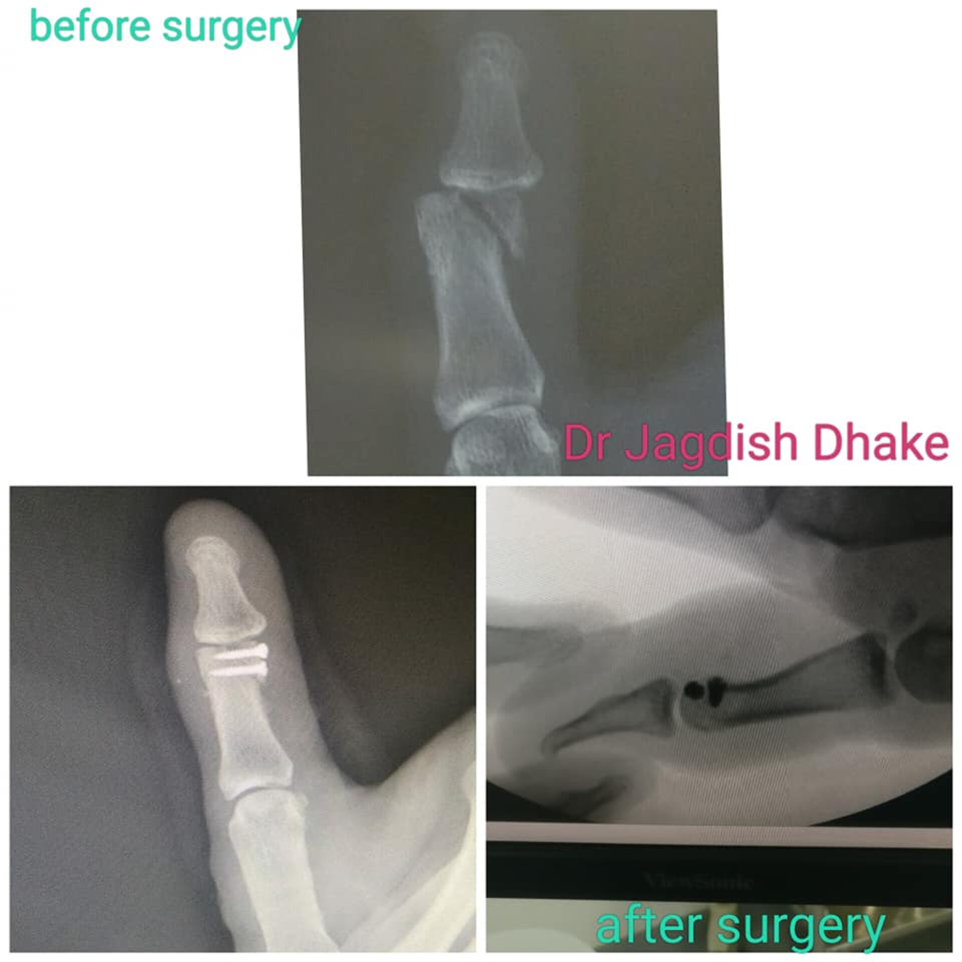 Hand Injury Case | Dr. Jagdish Dhake | Orthopedic Surgeon in Bibvewadi