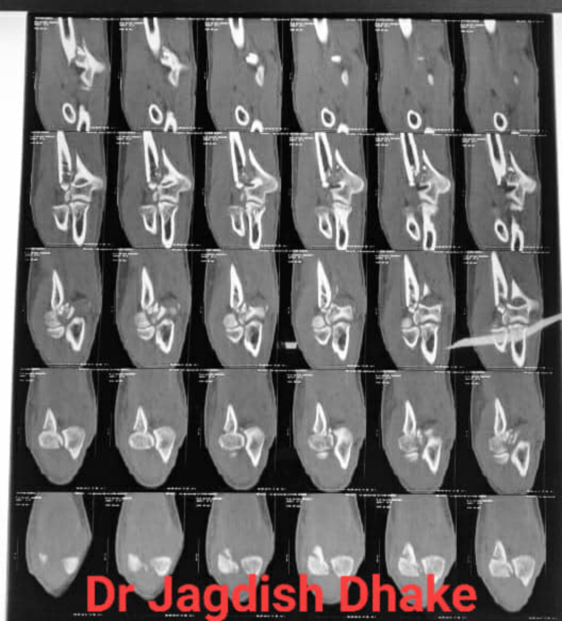 Distal Humerus Comminuted Fracture | Dr. Jagdish Dhake