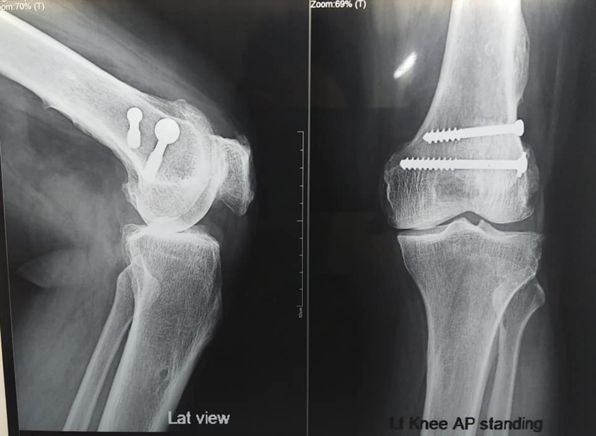 60-year male undergoes Bilateral Total Knee Replacement | Dr. Jagdish Dhake