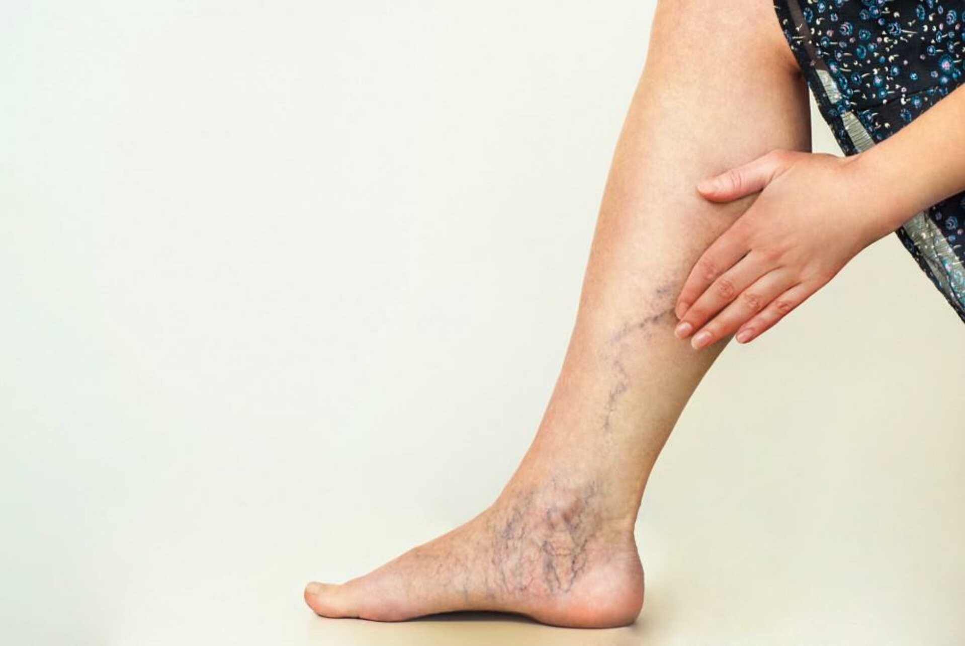 What Factors Contribute to Varicose Veins | Dr. Advait Kothurkar