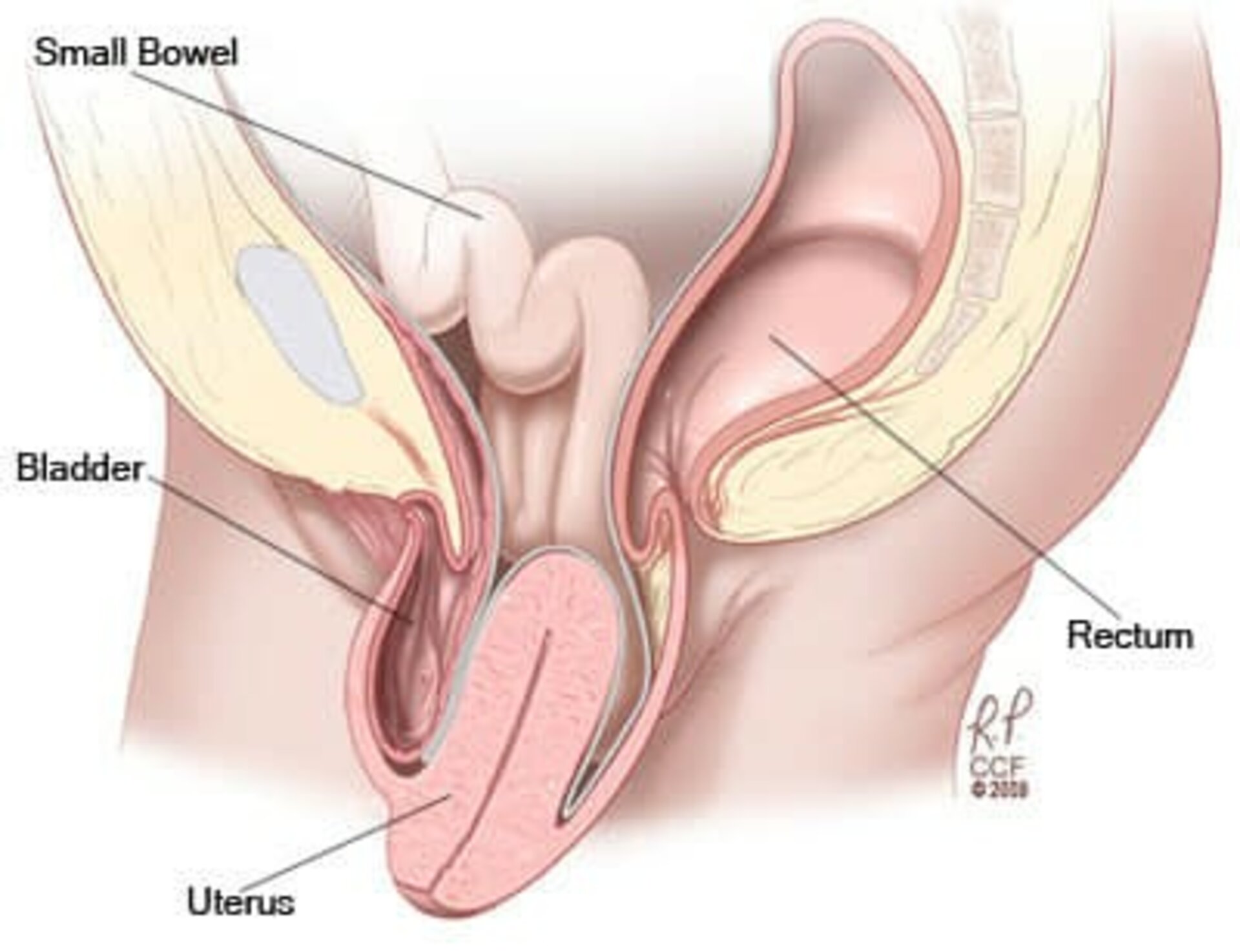 A rare Pelvic Organ Prolapse Surgery