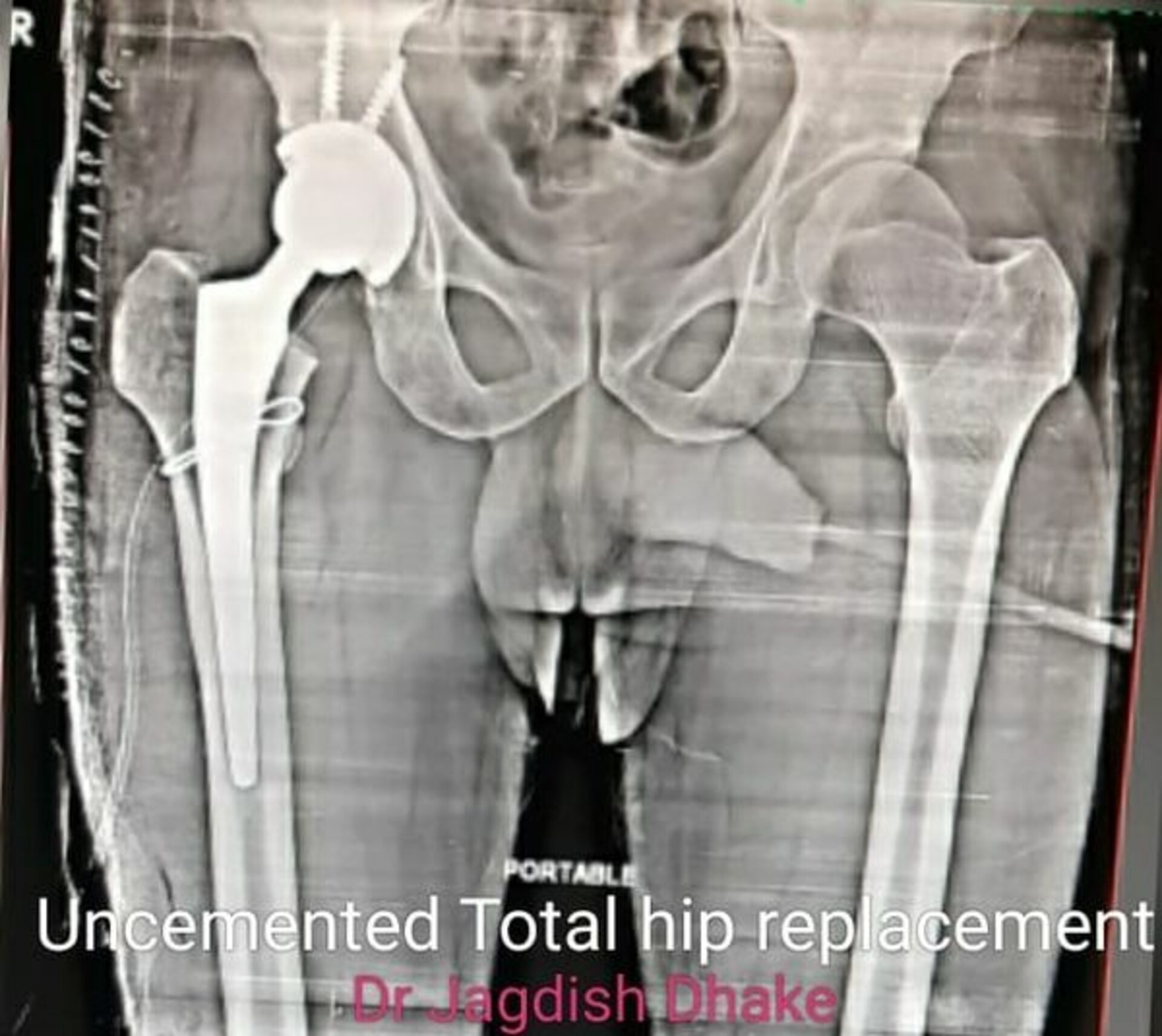 Total Hip Replacement | Dr. Jagdish Dhake