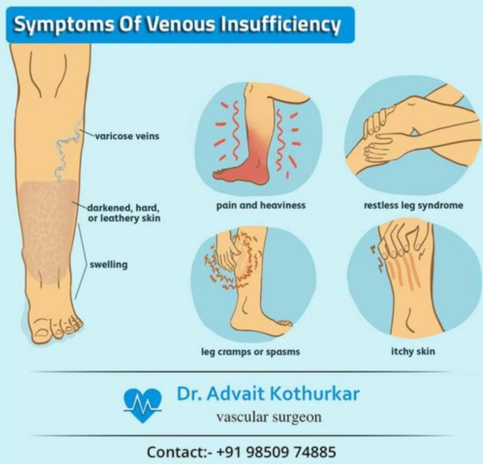 Chronic Venous Insufficiency - Dr. Advait Kothurkar
