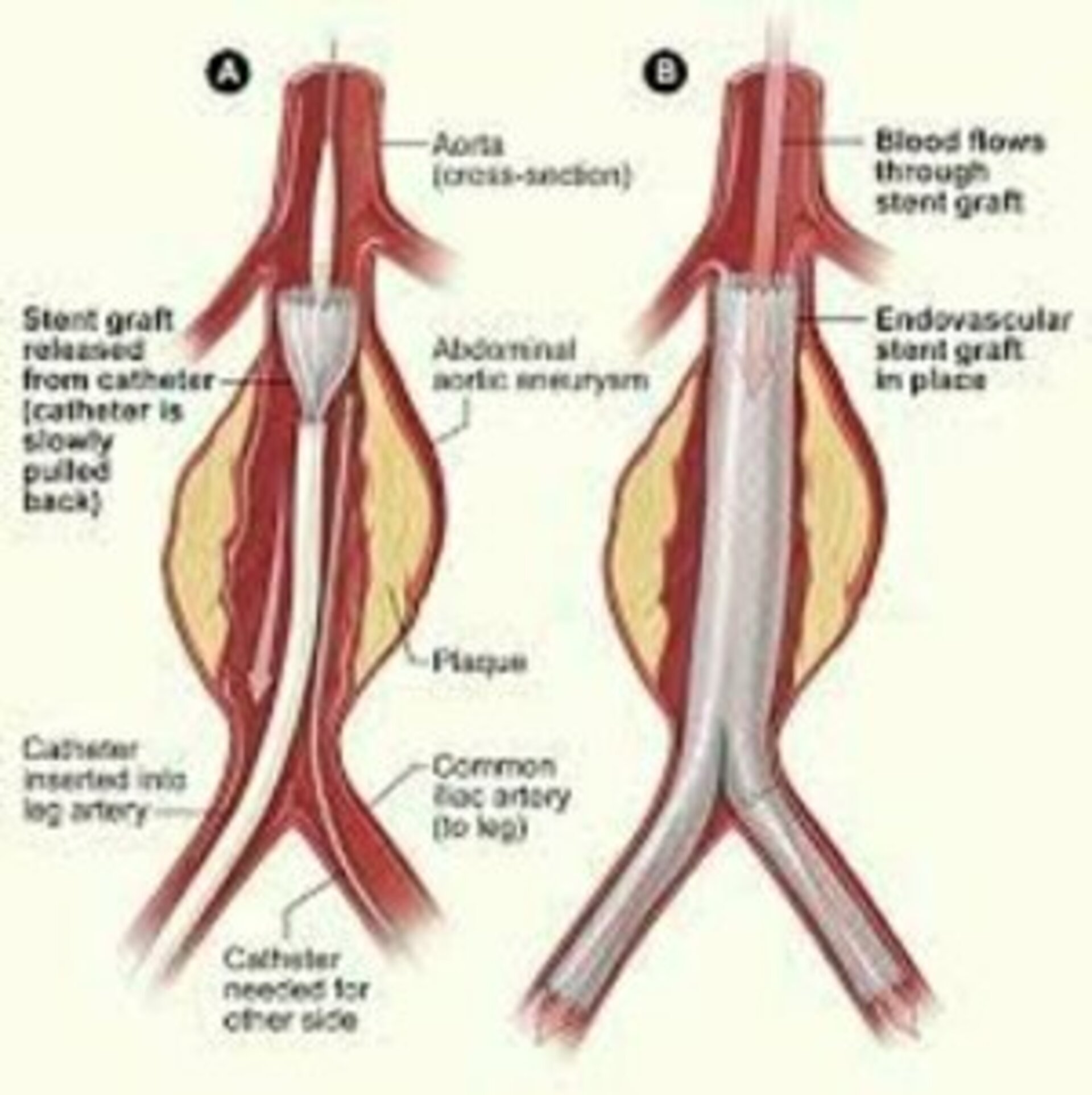 Surgery for Aortic Aneurysms | Dr. Advait Kothurkar