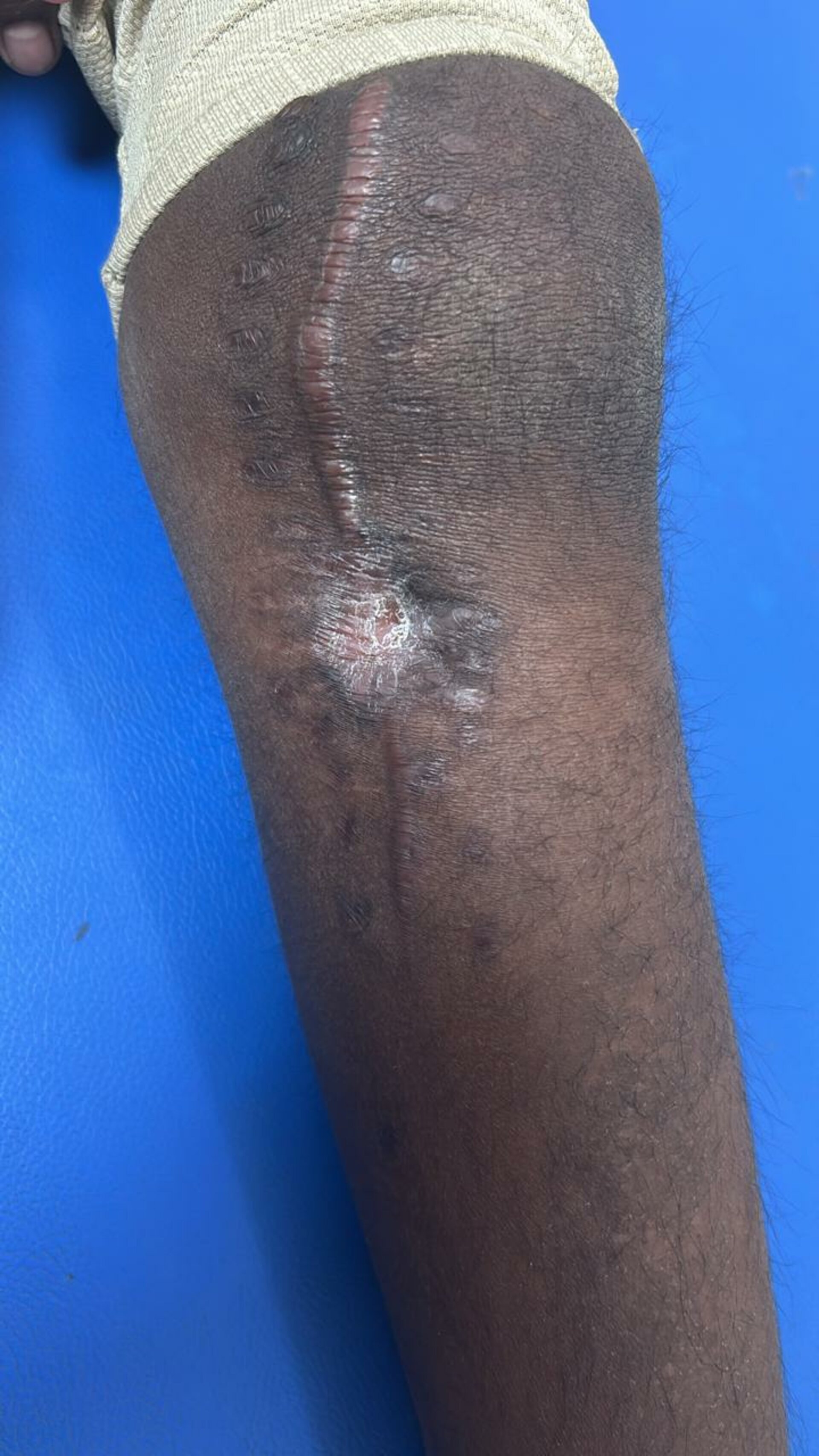 Dr. Preeti Ajapuje Successfully Treats Pediatric Osteomyelitis Case