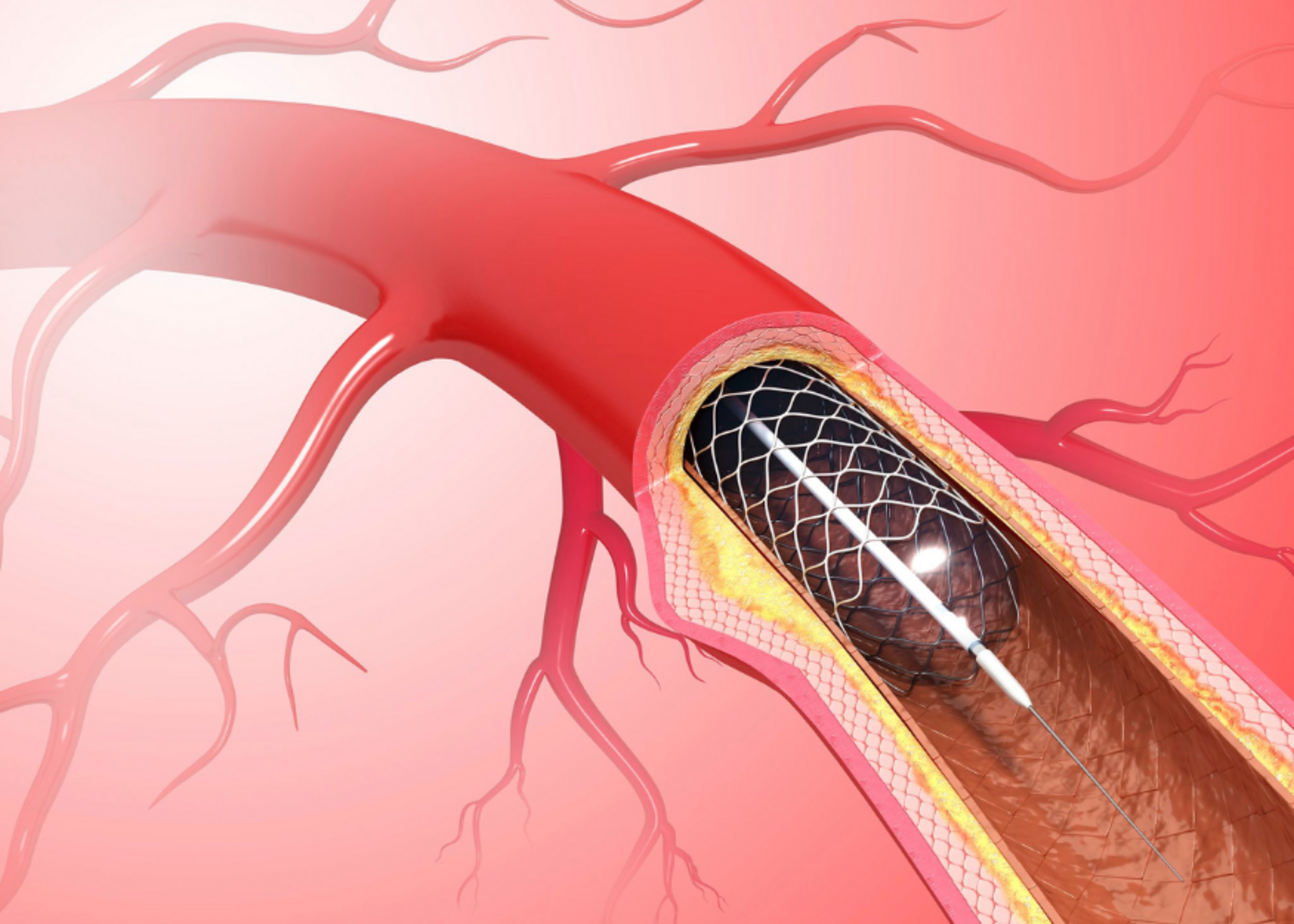 Coronary Angioplasty | Dr. Mehul Rathod