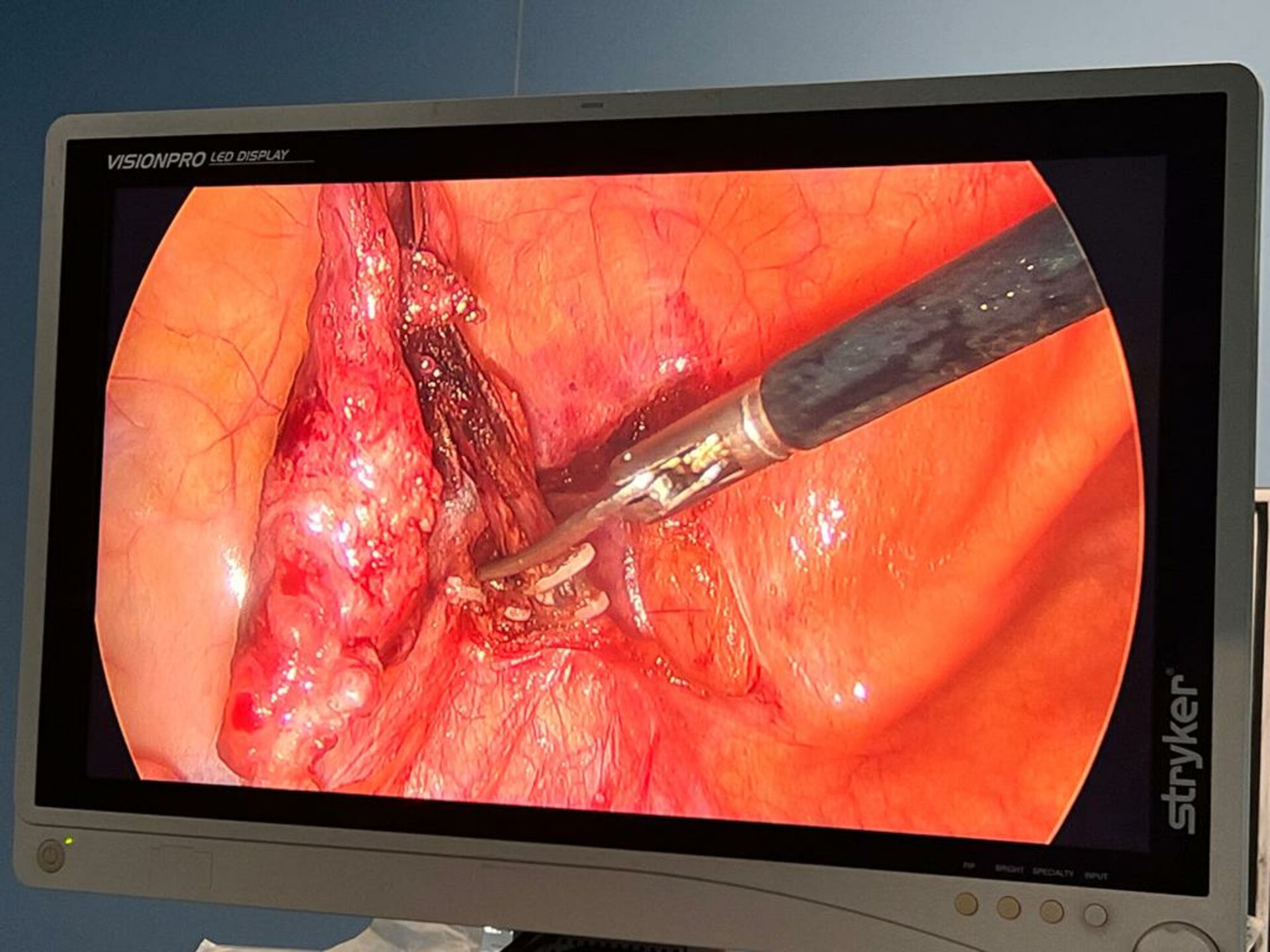 Left Laparoscopic Orchidectomy and Left testicular Implant surgery | Dr. Bhoopat Bhati