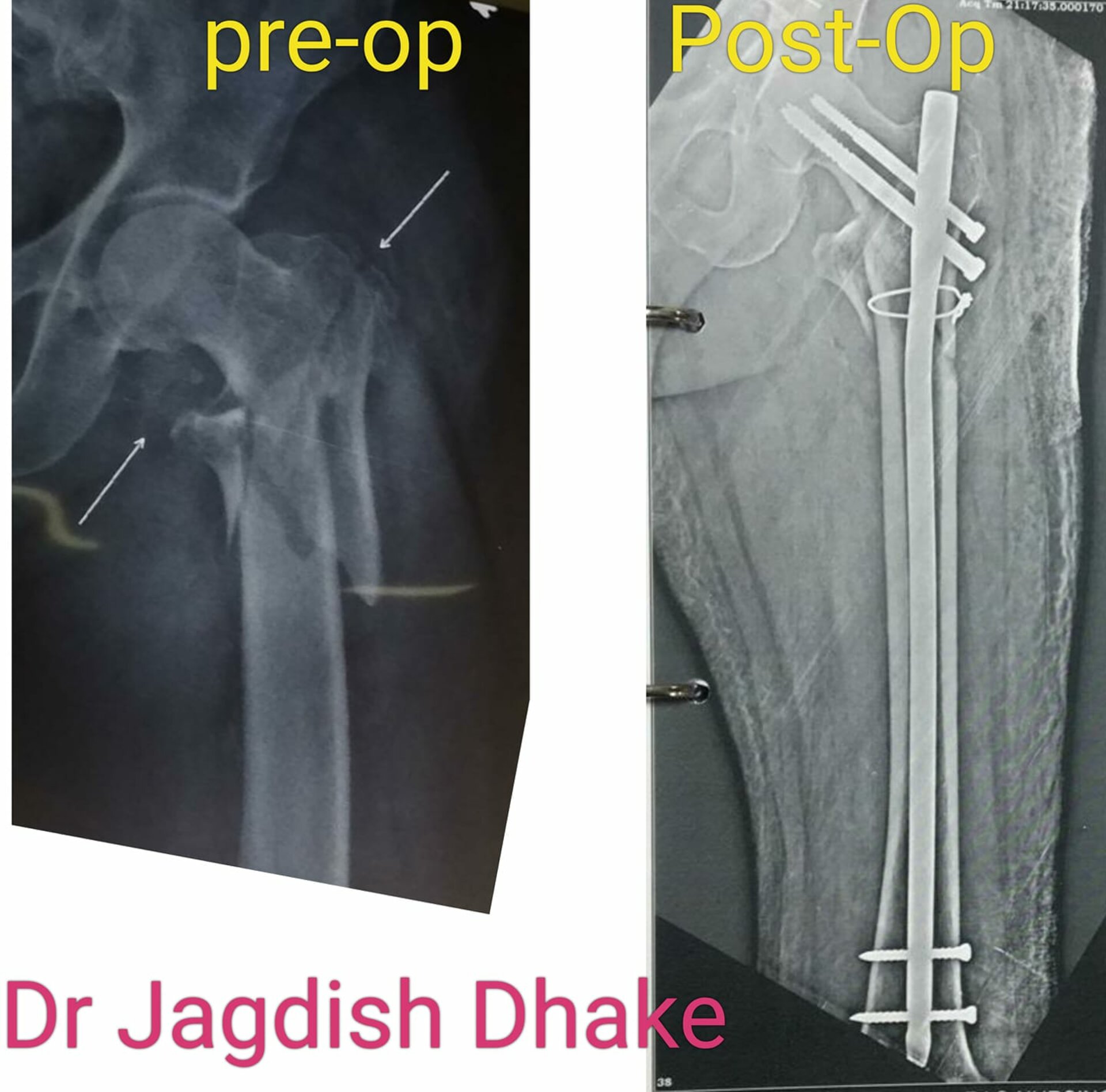 Happy Patient | Dr. Jagdish Dhake - Orthopedic Surgeon