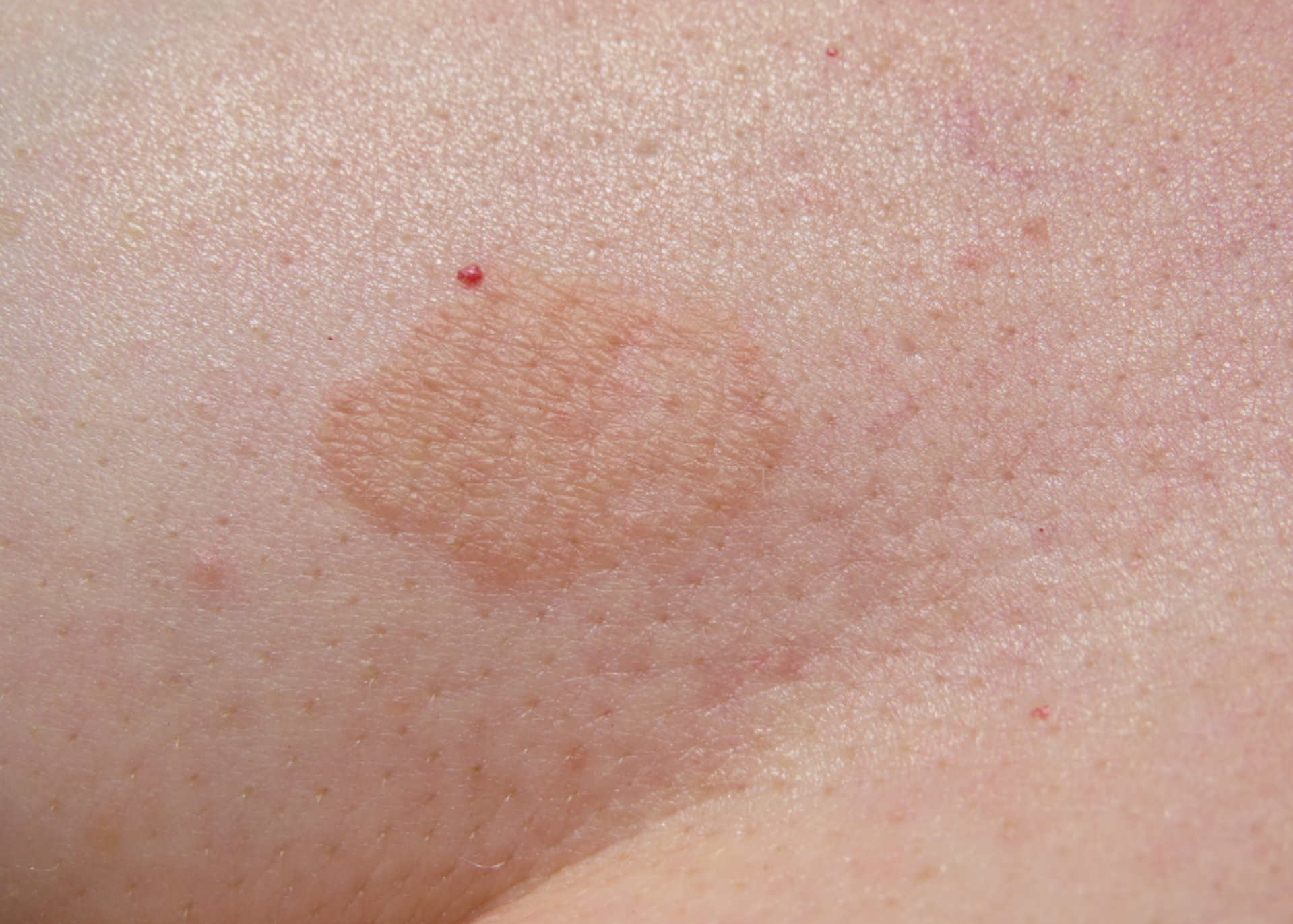 Fungal Infections Treatments in Katraj | Dr. Sandhya Hippargekar