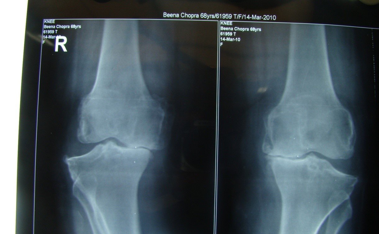 Treatment for Osteoarthritis | Dr. Sandeep Chauhan