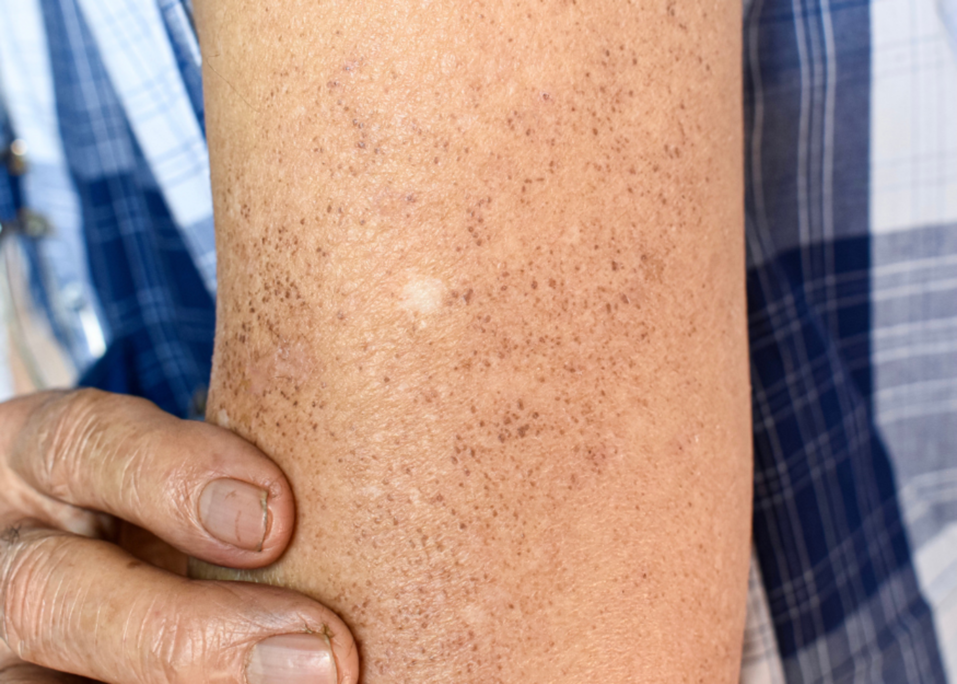 White Spots on Skin Treatment | Dr. Sandhya Hippargekar