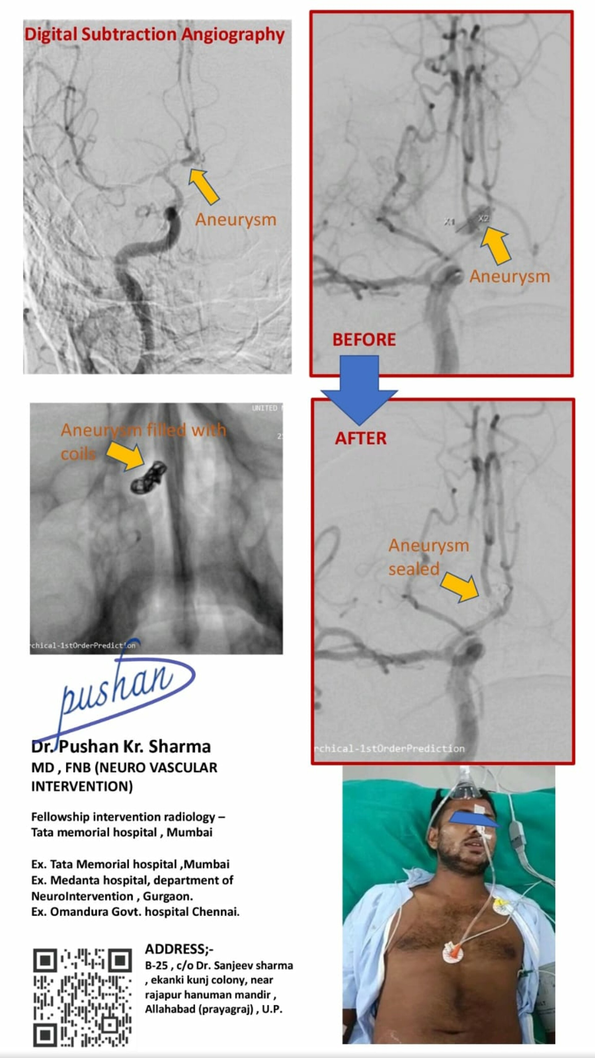 Non surgical treatment of brain aneurysm coiling in Prayagraj