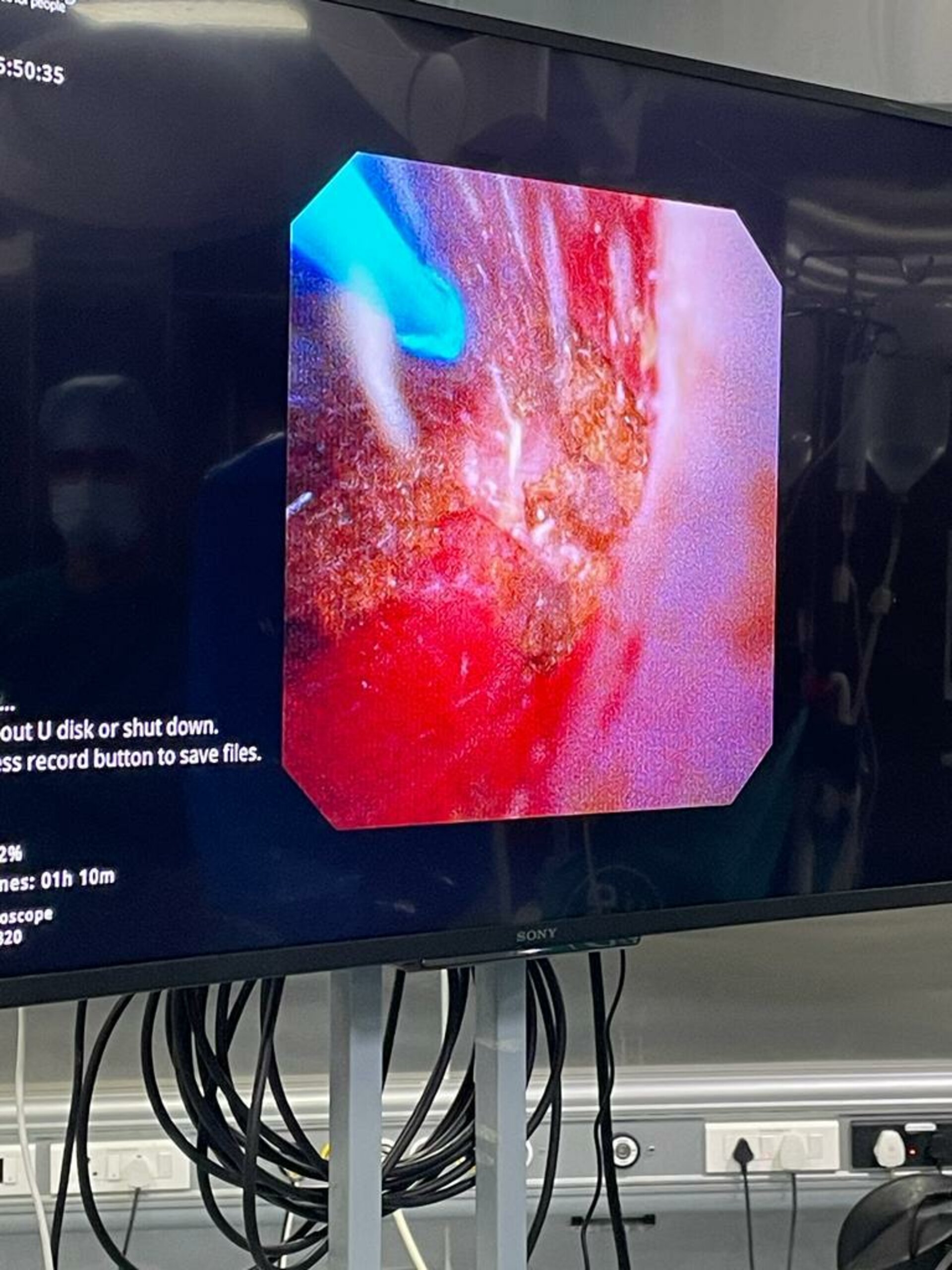 RIRS procedure.