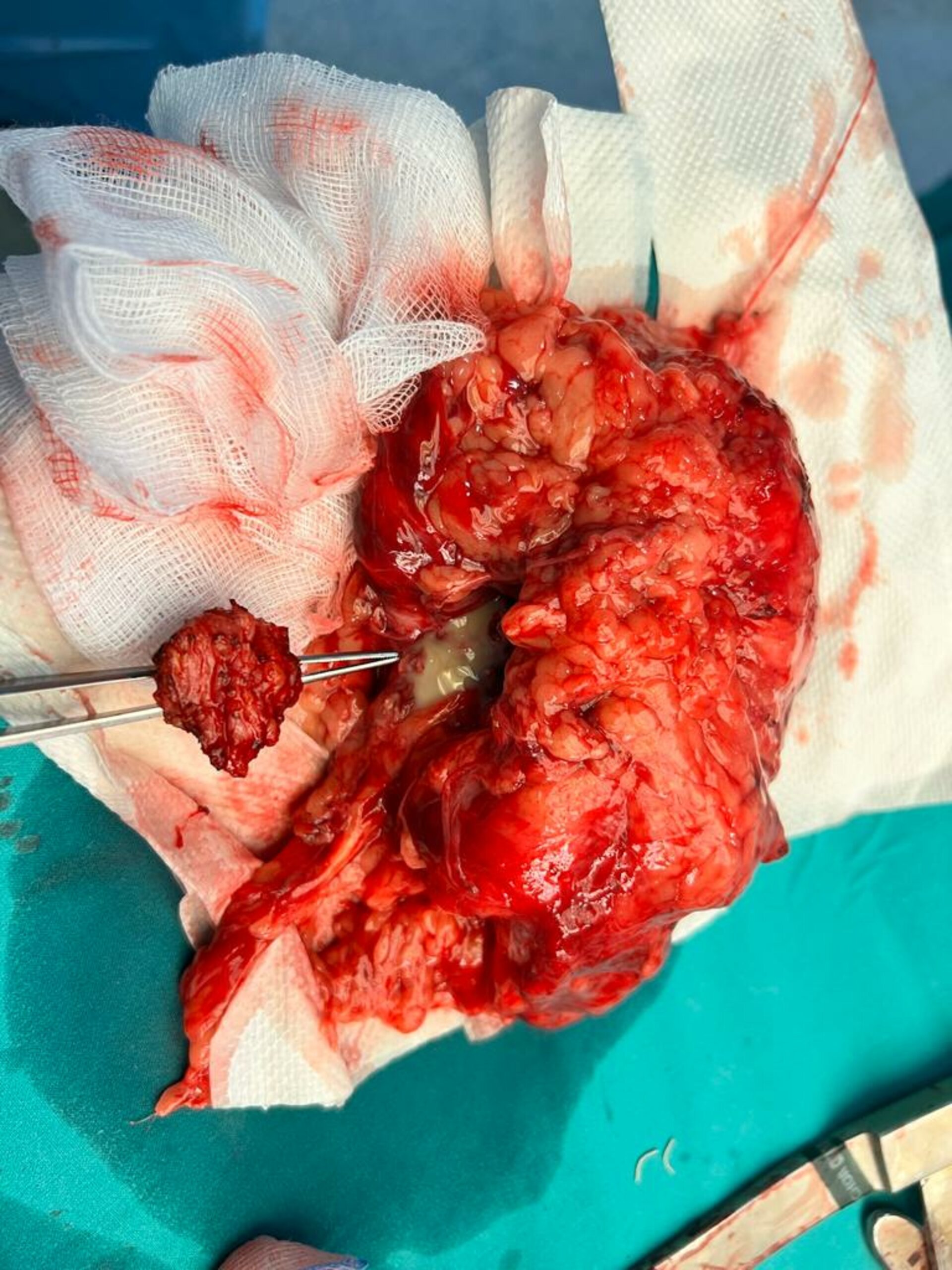 Nephrocutaeous Fistula Treated by Open Nephrectomy | Dr. Bhoopat Bhati