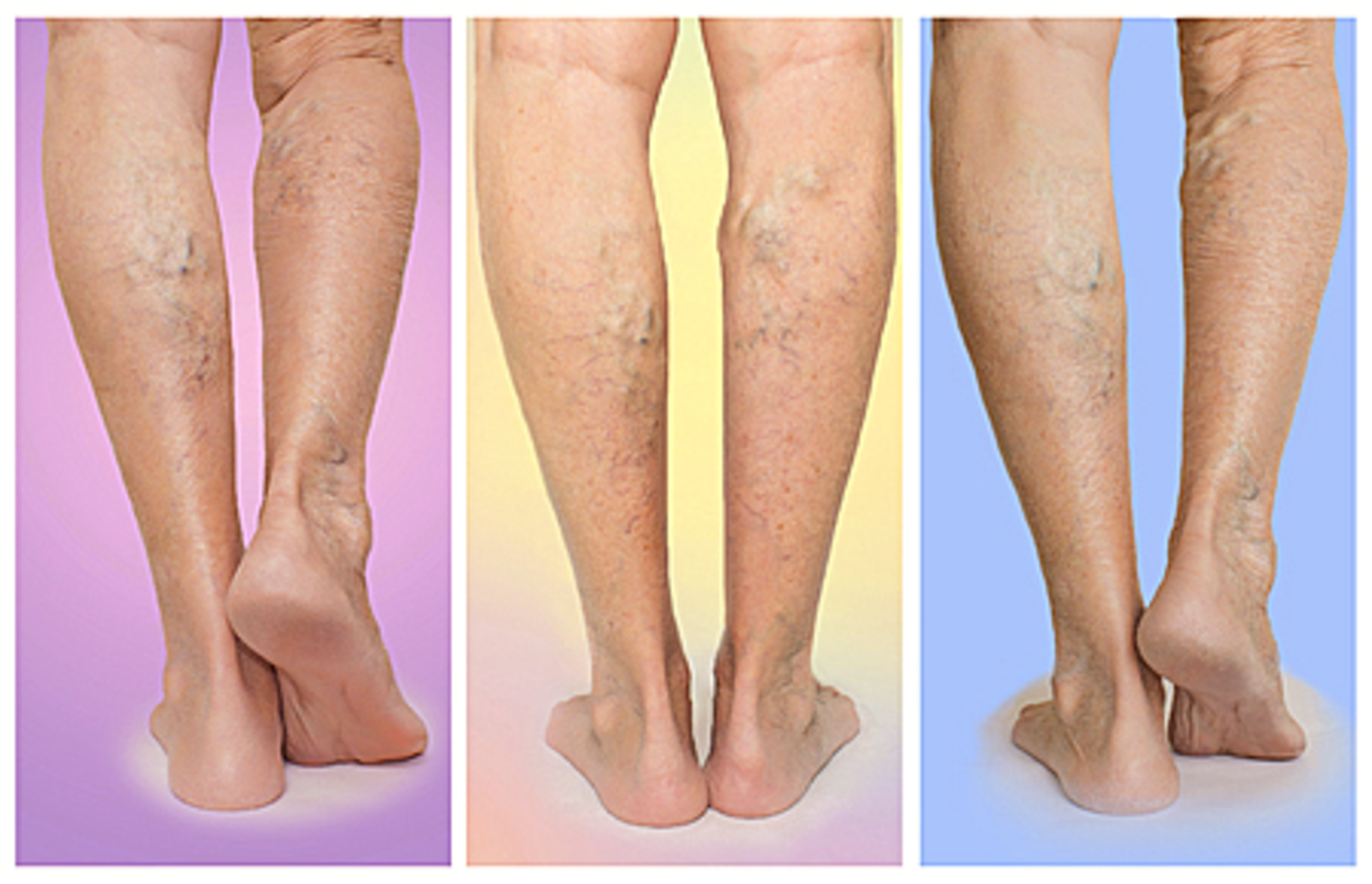 Peripheral Artery Disease | Dr. Advait Kothurkar