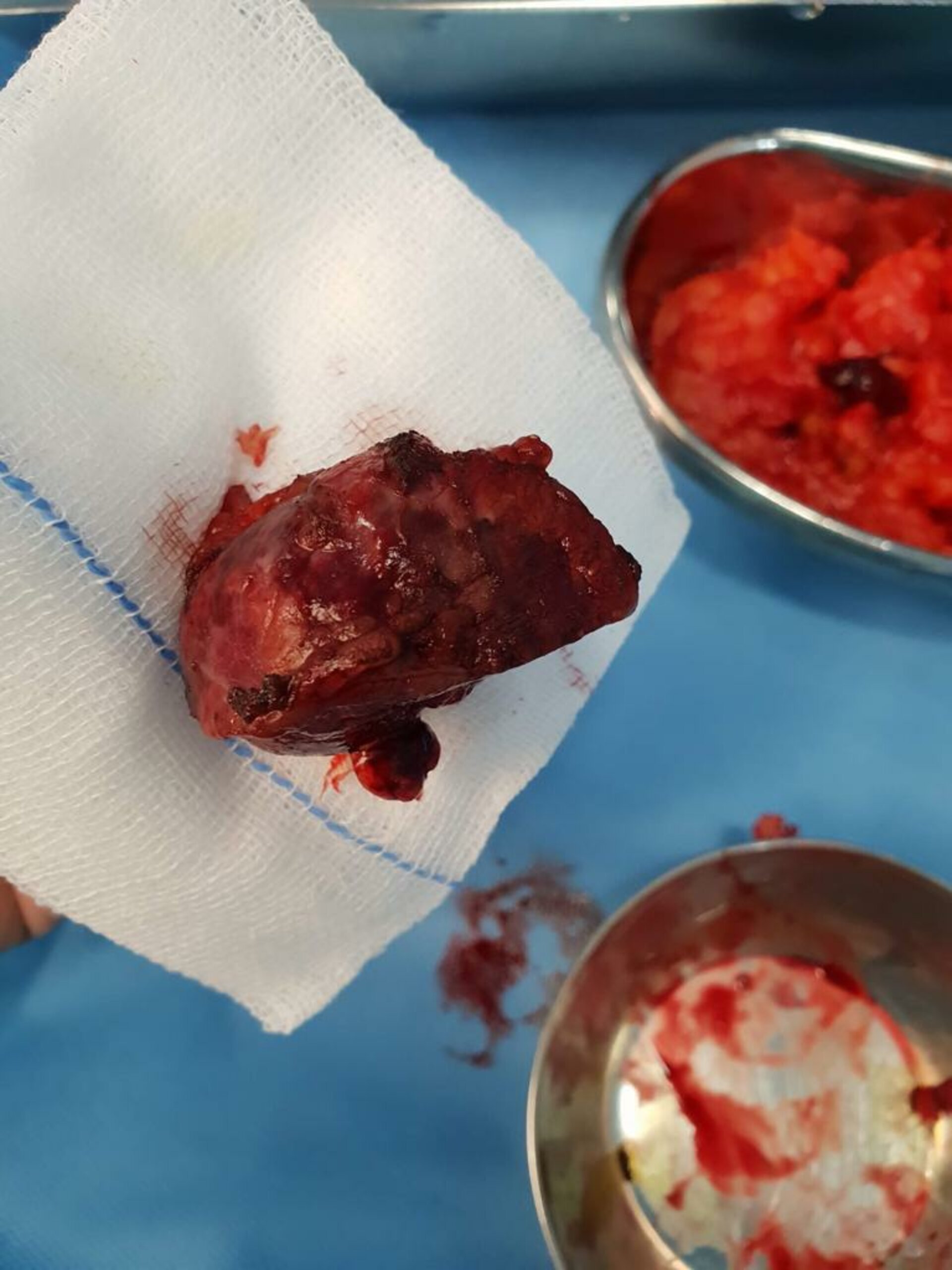Abdomen Pain Caused by Left Renal mass Treated with Open Partial Nephron Sparing | Dr. Bhoopat Bhati