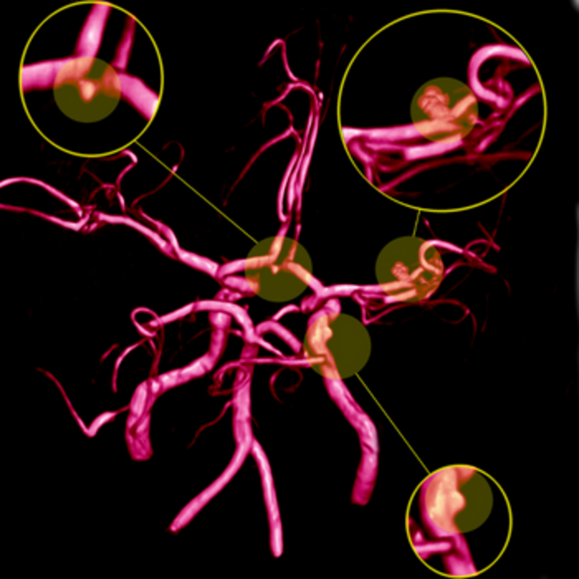 peripheral aneuysm treatment in Prayagraj - Dr Pushan Sharma