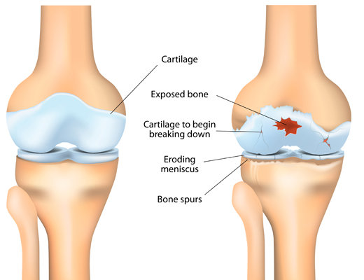 How is osteoarthritis treated? explained by Dr. Sandeep Chauhan