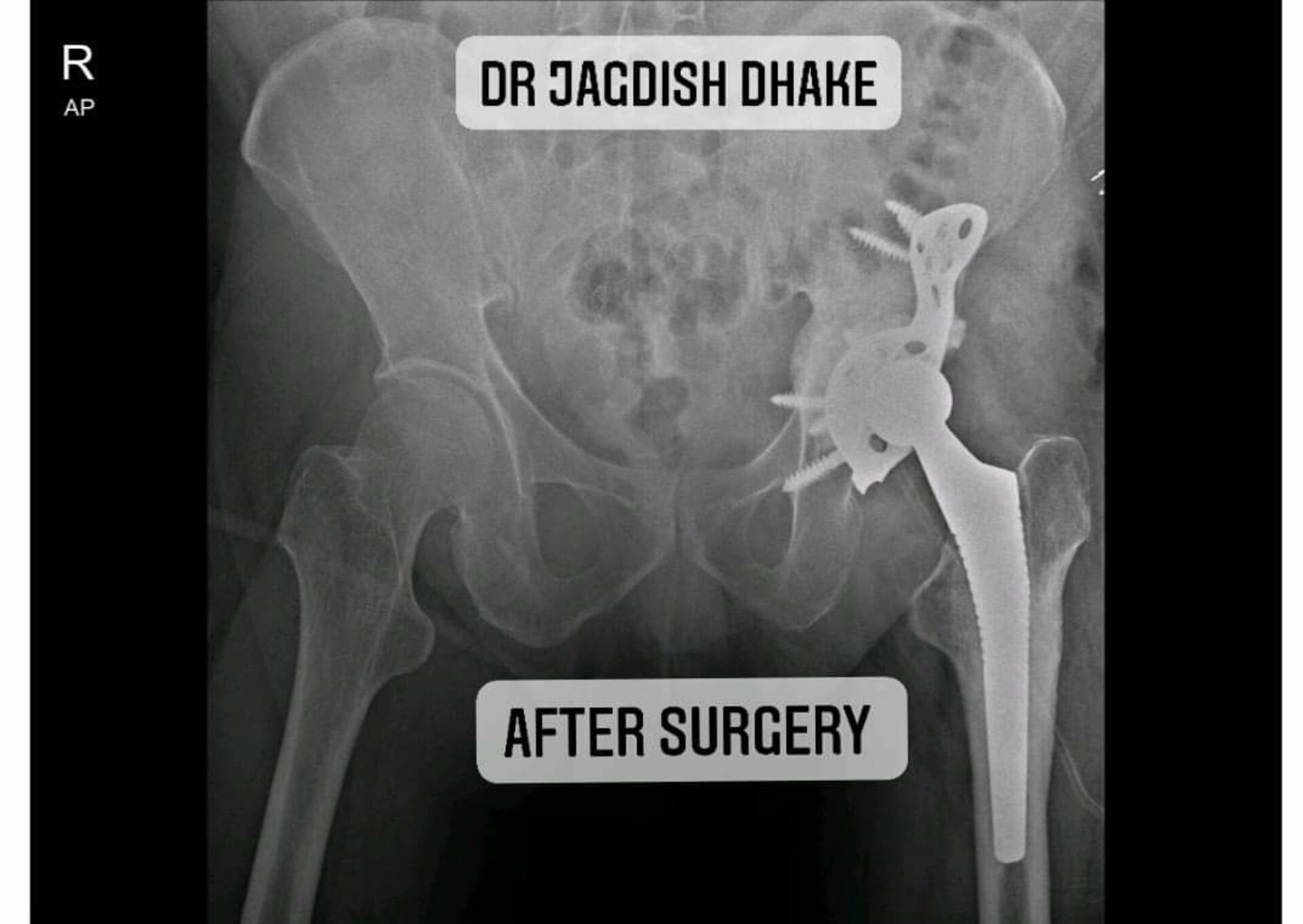 Bipolar Head Removal, Bone Grafting and Acetabular Cage Fixation, conversion to Total Hip replacement by Dr. Jagdish Dhake