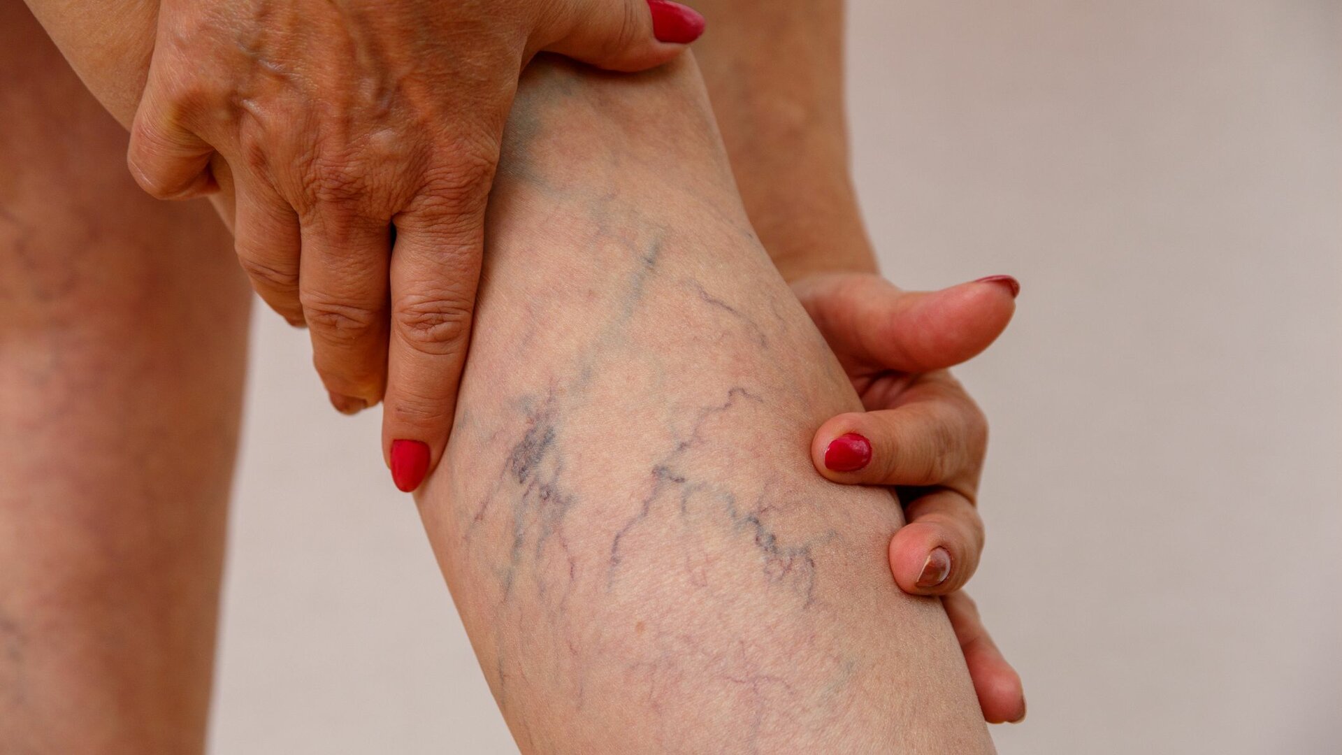Spider Veins