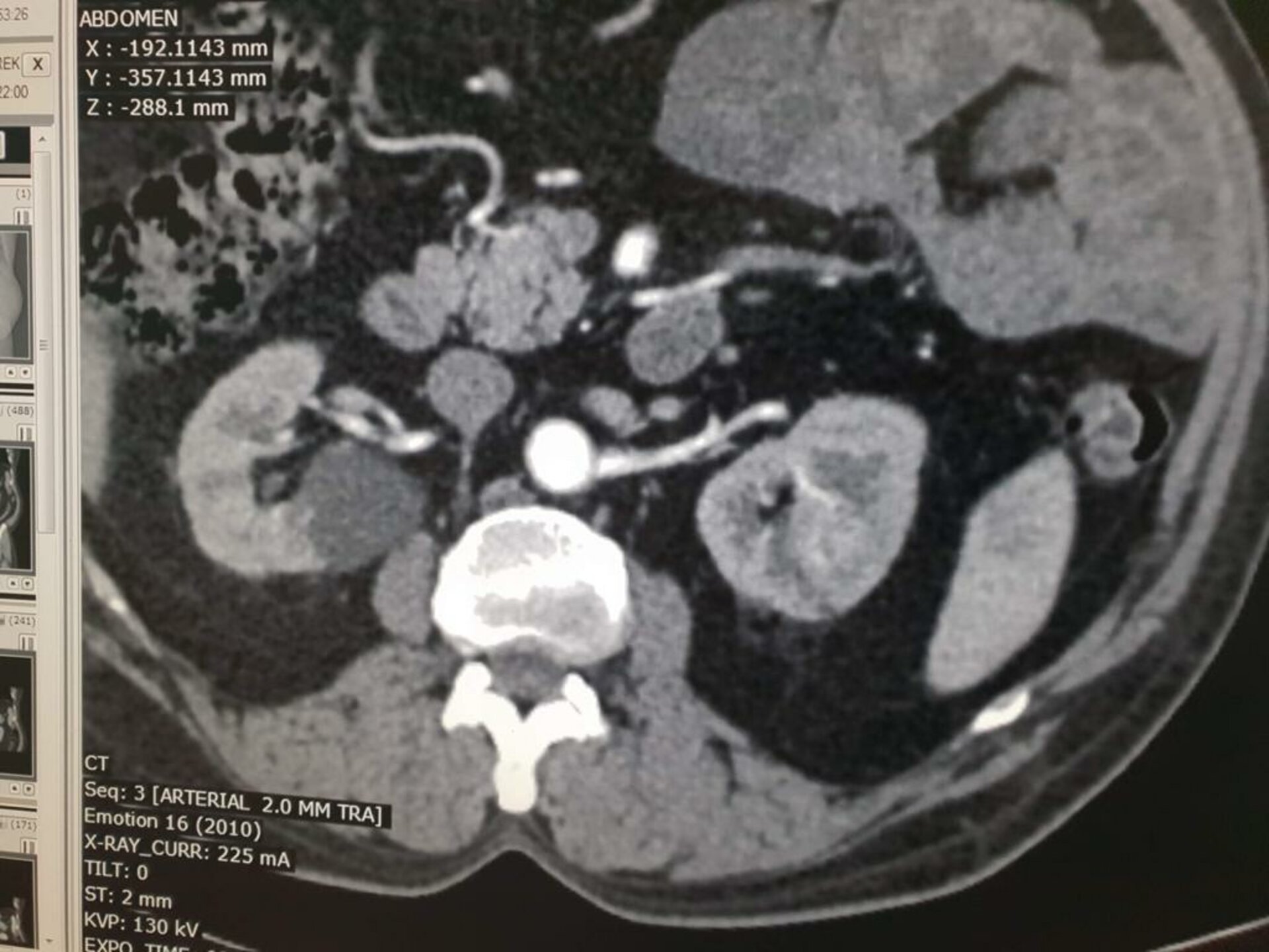 Abdomen Pain Caused by Left Renal mass Treated with Open Partial Nephron Sparing | Dr. Bhoopat Bhati