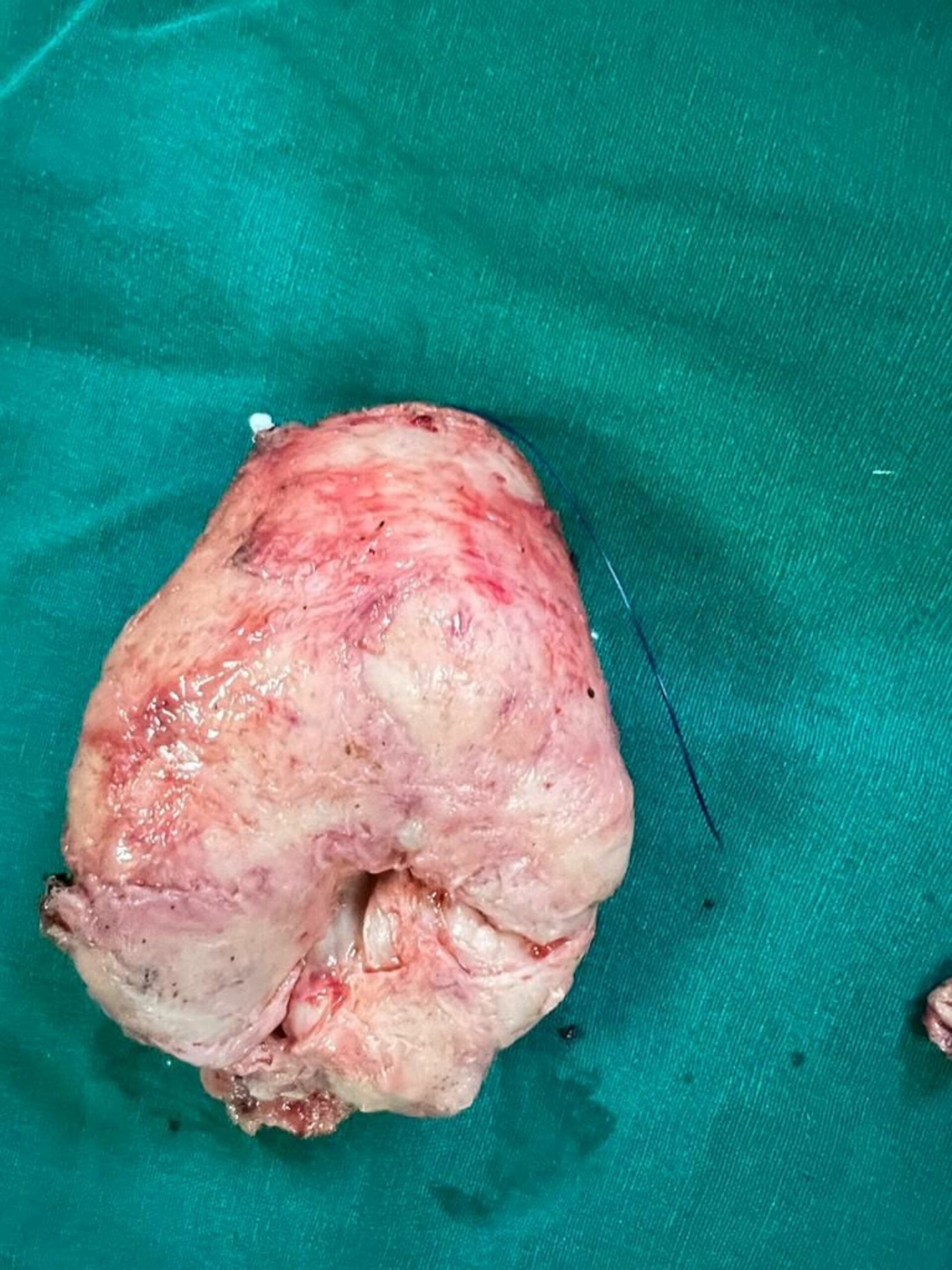 Robotic Prostatectomy in Pune | Dr. Bhoopat Bhati | Urologist