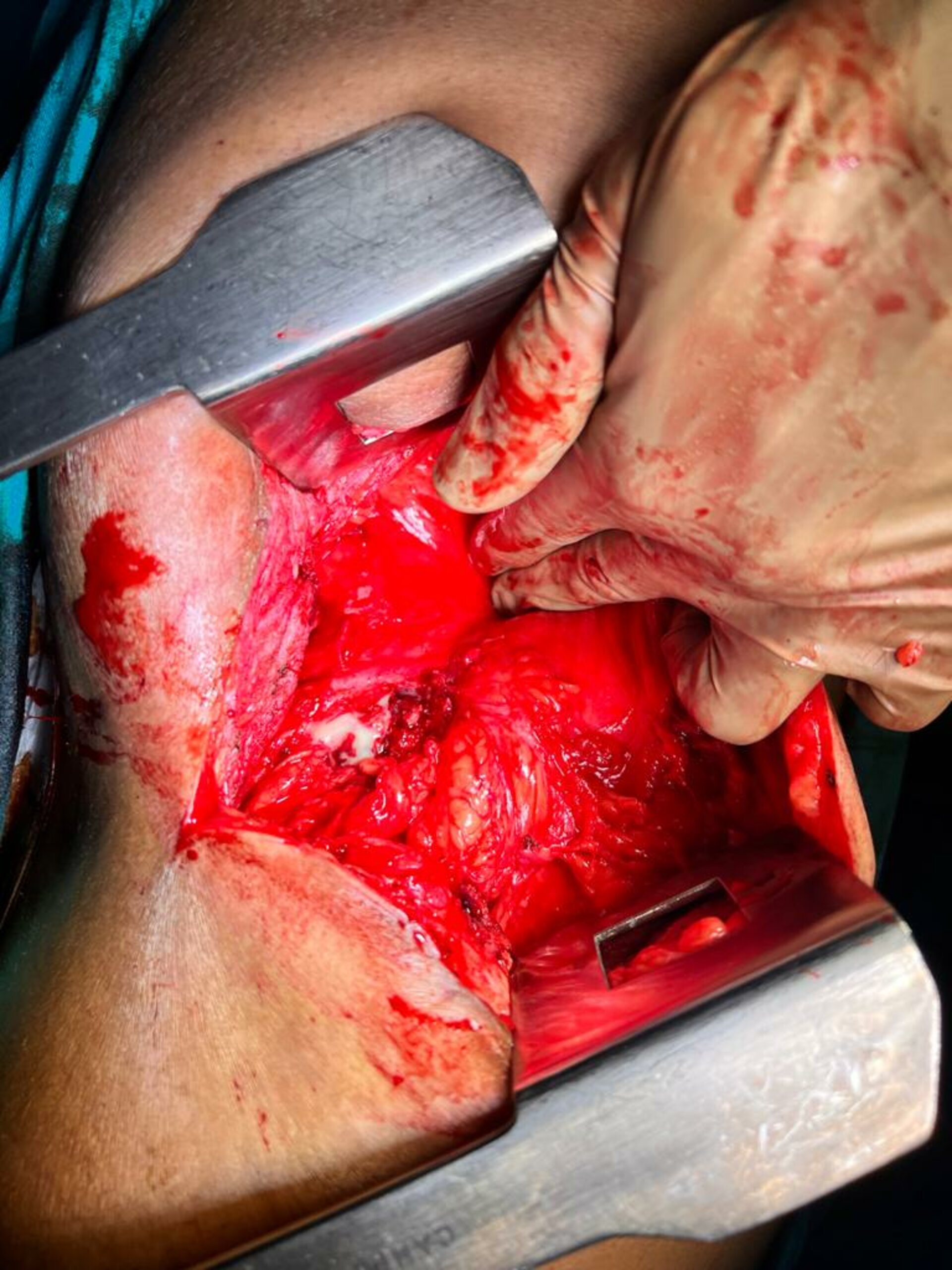 Nephrocutaeous Fistula Treated by Open Nephrectomy | Dr. Bhoopat Bhati