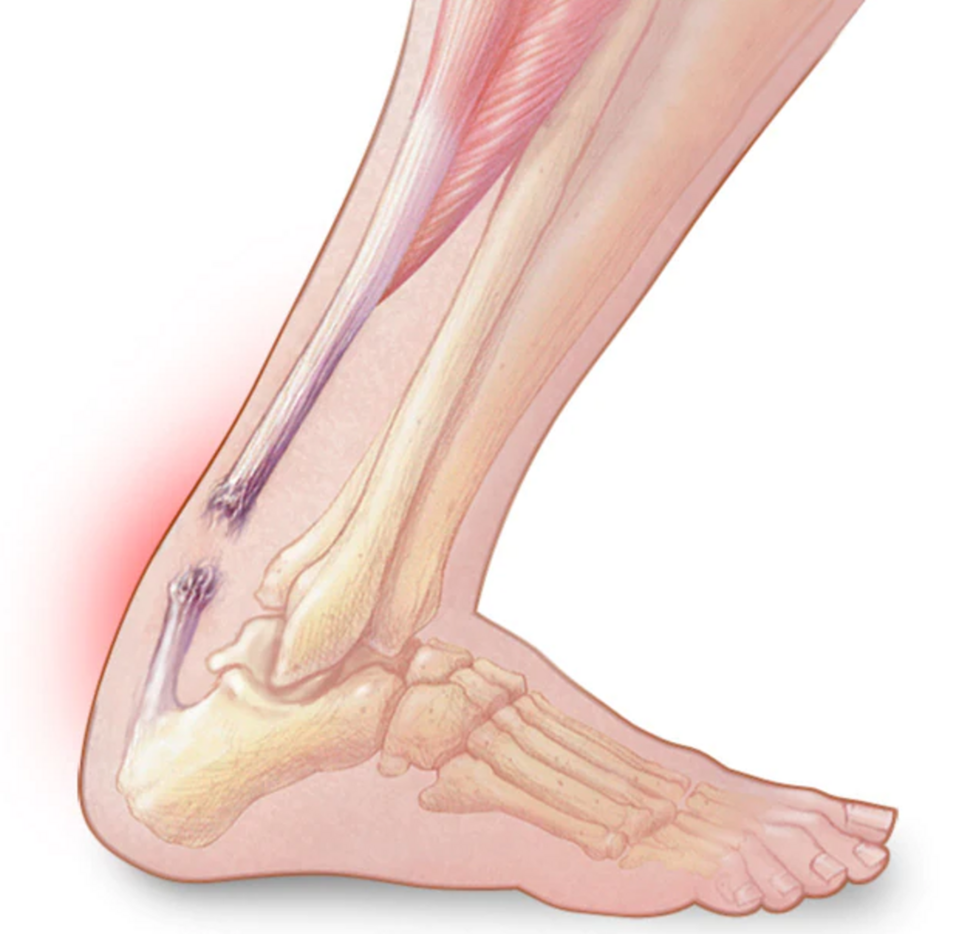 Achilles Tendon