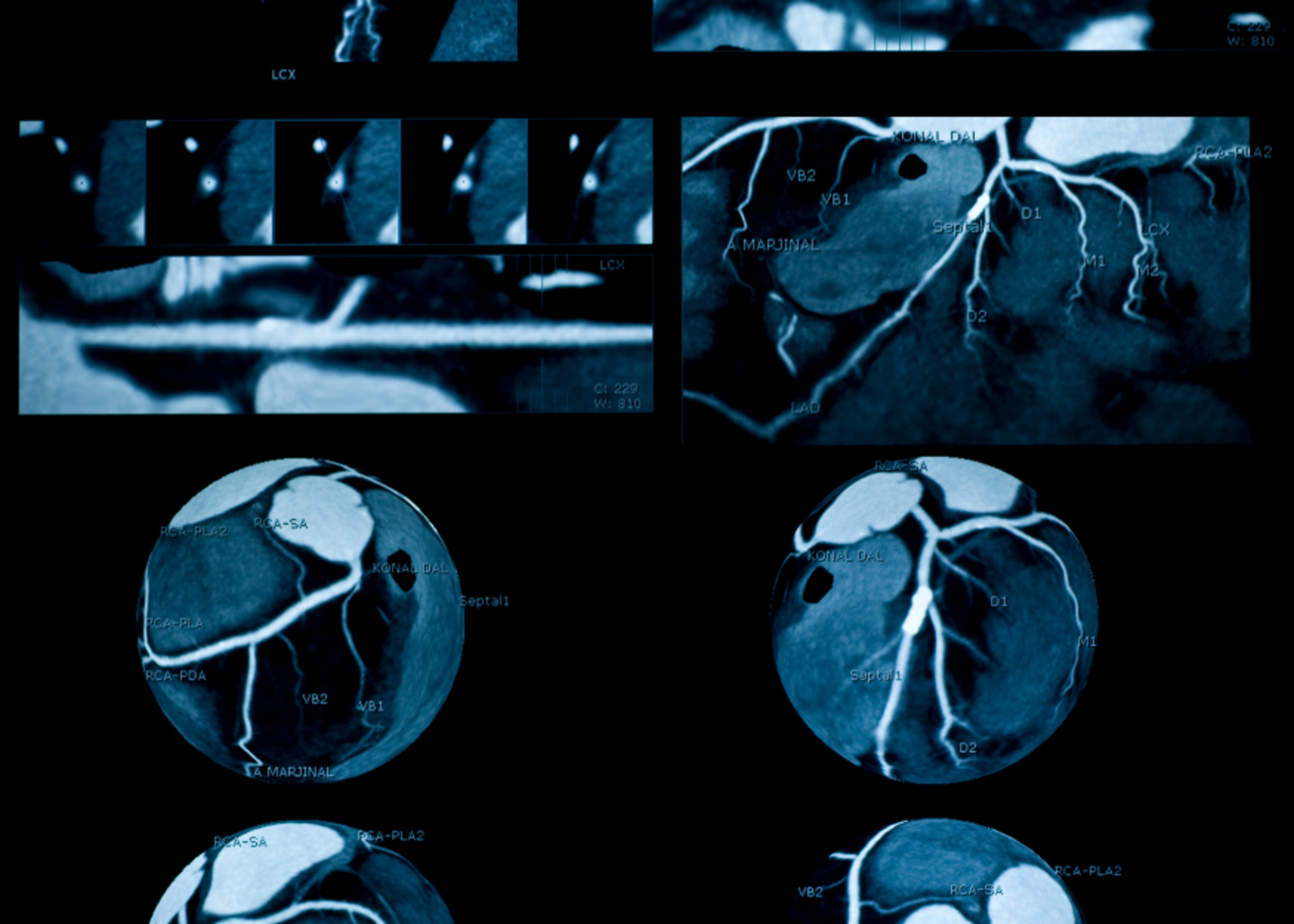 Coronary Angiography | Dr. Mehul Rathod