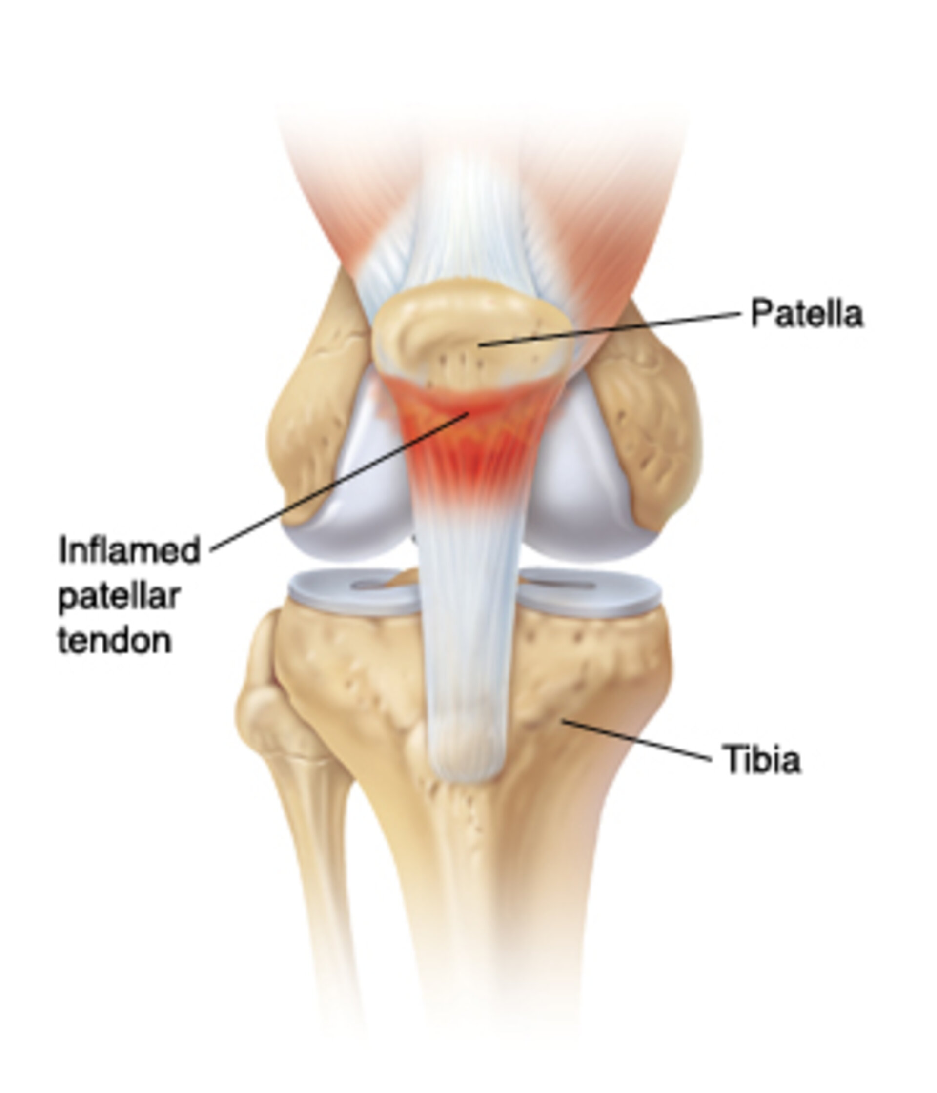 Patellar Tendinopathy