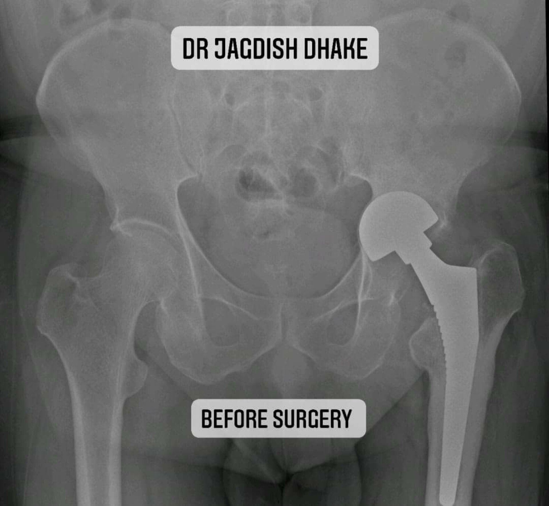Bipolar Head Removal, Bone Grafting and Acetabular Cage Fixation, conversion to Total Hip replacement by Dr. Jagdish Dhake