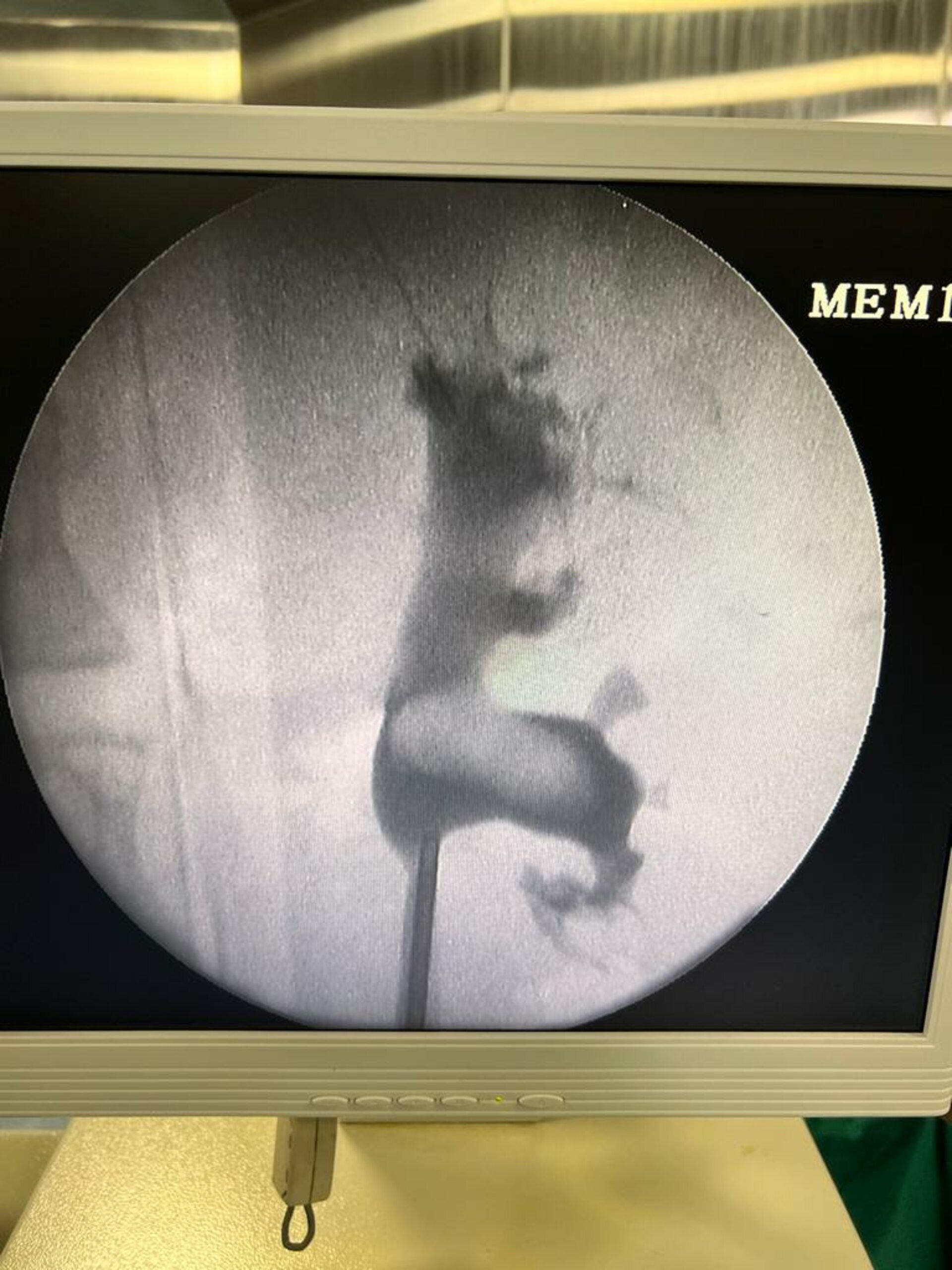 RIRS procedure.
