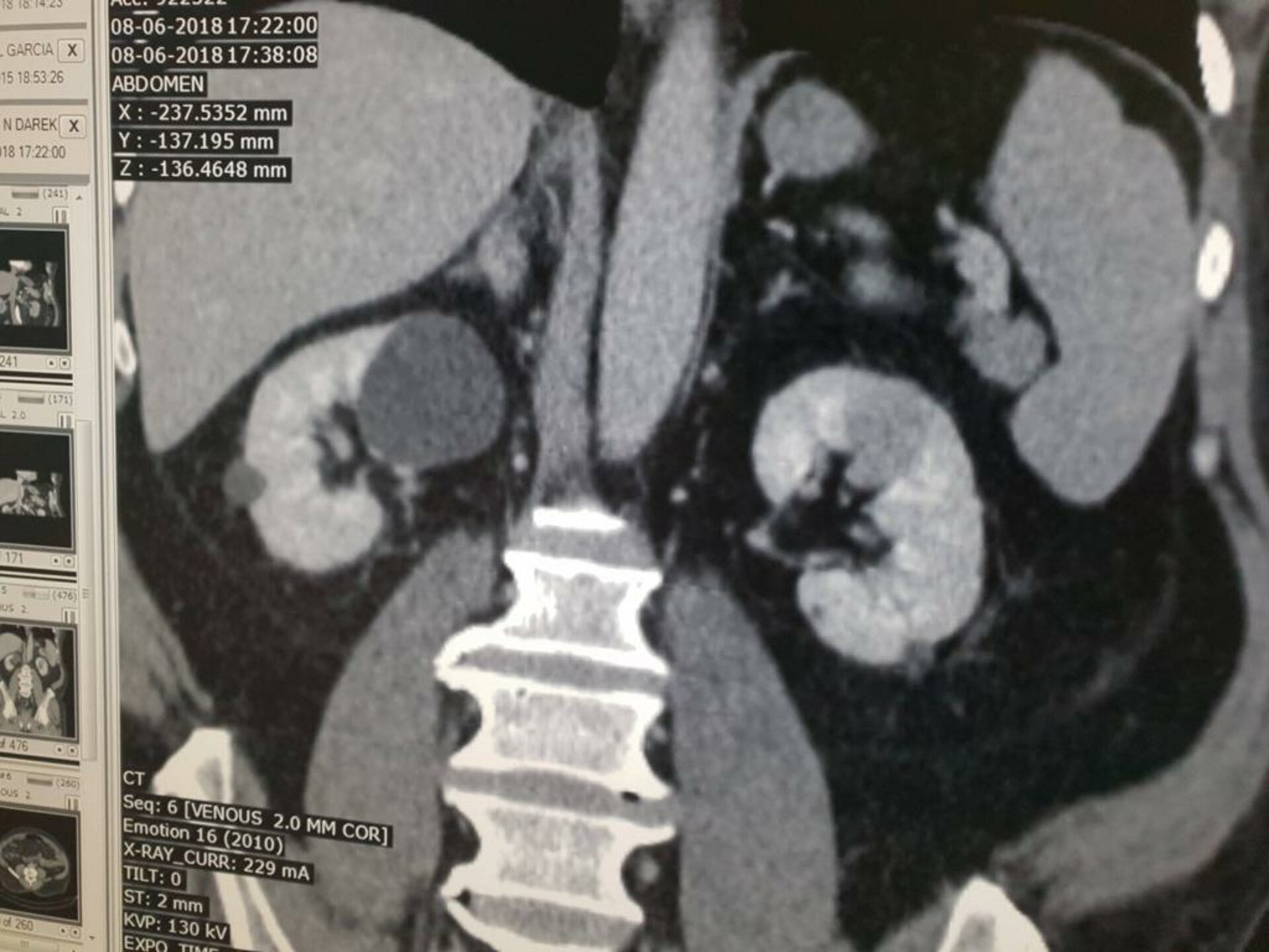 Abdomen Pain Caused by Left Renal mass Treated with Open Partial Nephron Sparing | Dr. Bhoopat Bhati