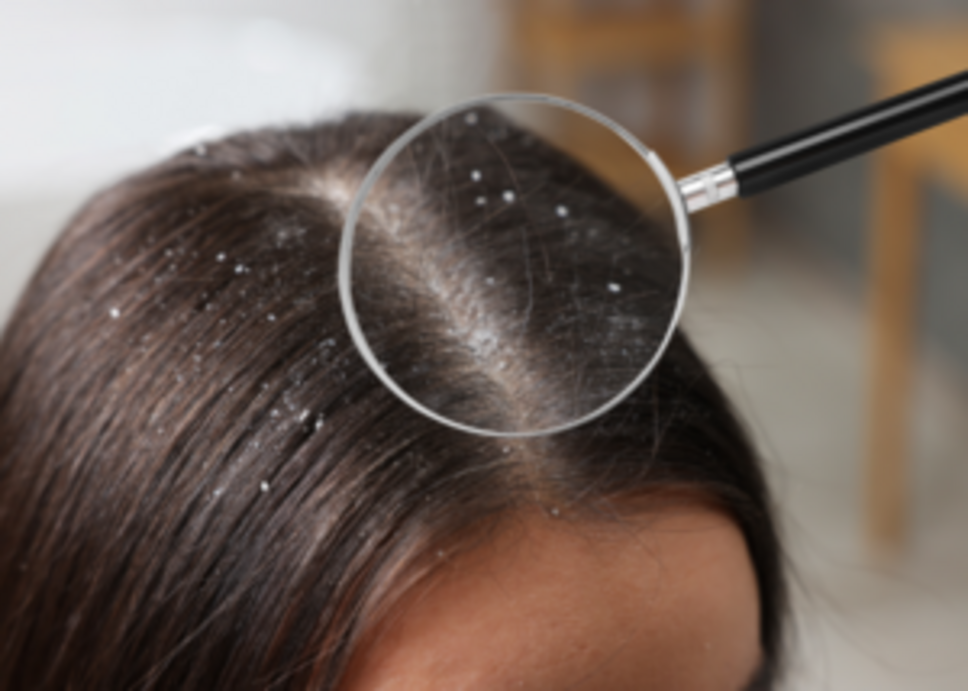 Dandruff: Causes, Treatment & Prevention by Dr. Sandhya Hippargekar