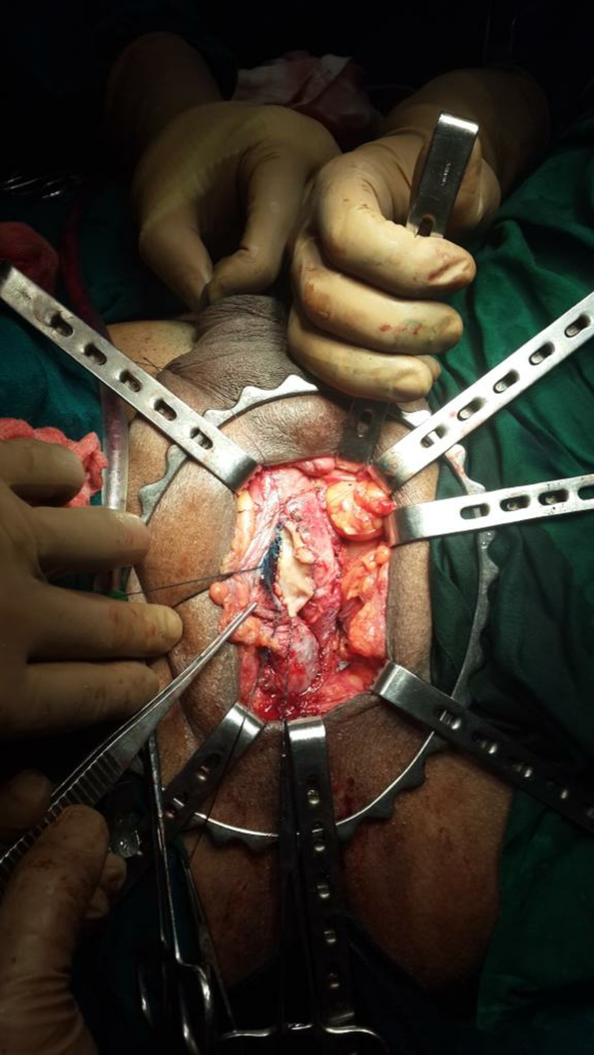 Difficulty in Urinating Treatment by Buccal Mucosa Graft Urethroplasty | Dr. Bhoopat Bhati