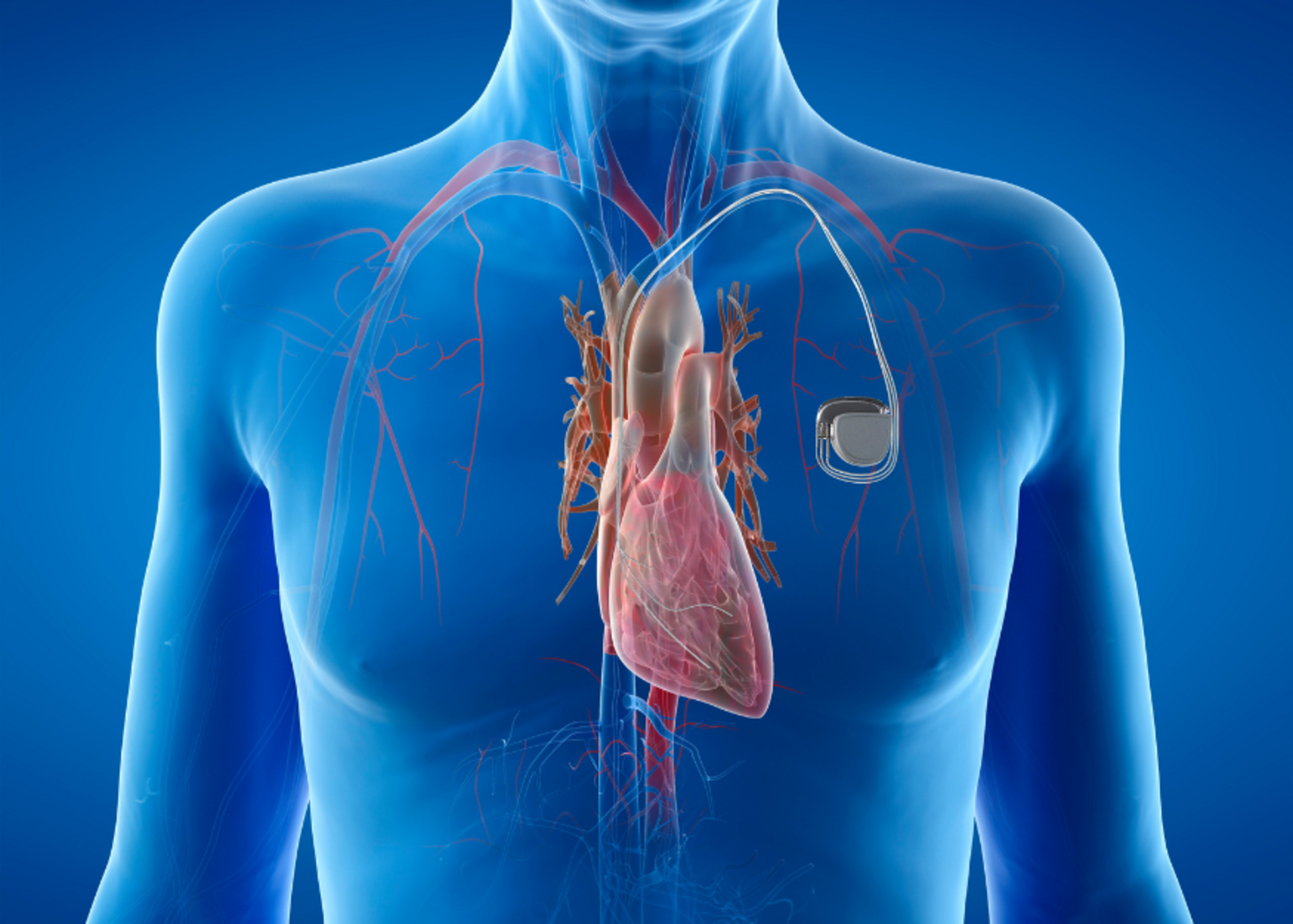 Pacemaker | Dr. Mehul Rathod