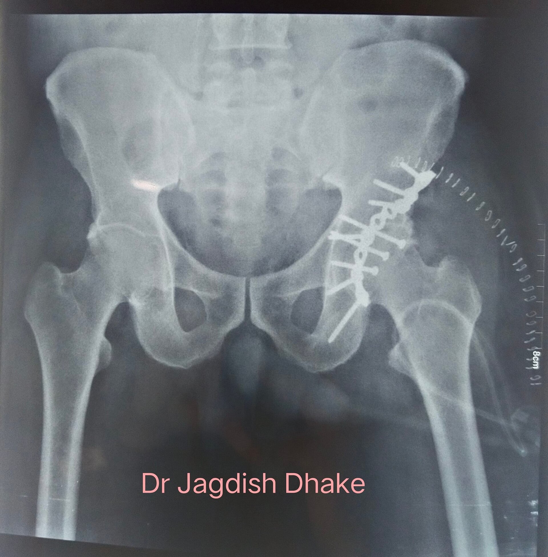 reconstruction of hip by Dr. Jagdish Dhake