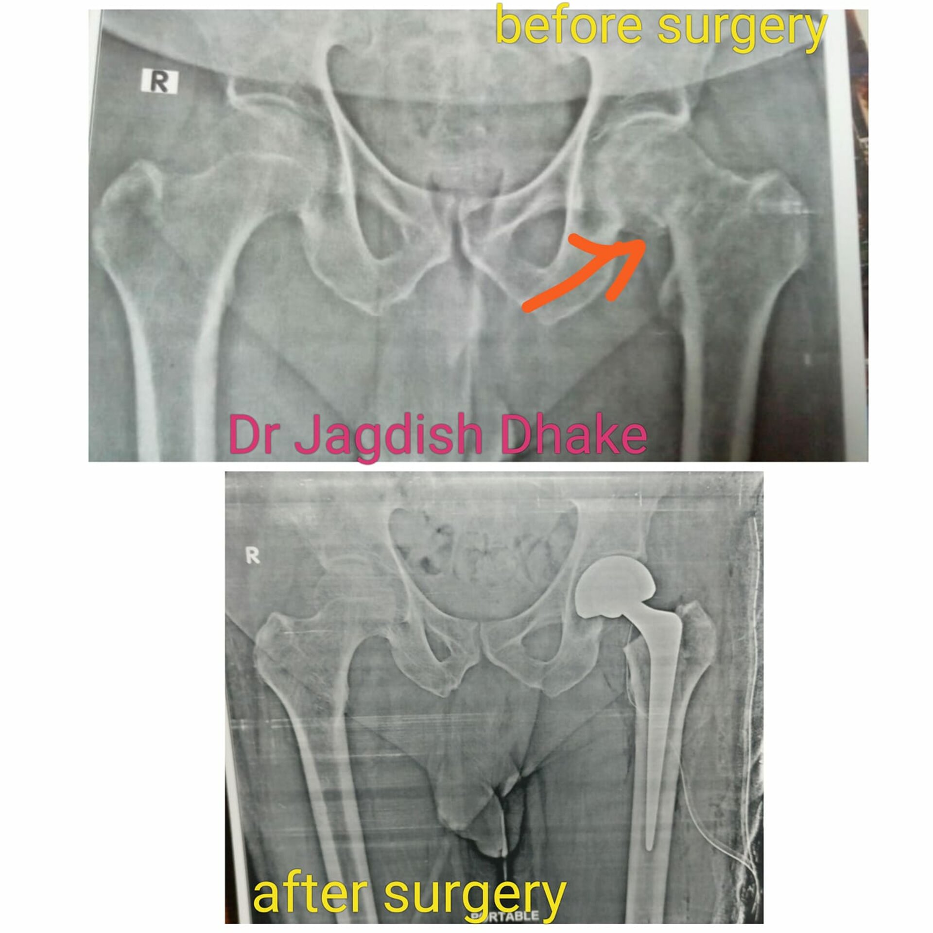 Fracture Neck Femur |Dr. Jagdish Dhake | Orthopedic Surgeon in Bibvewadi