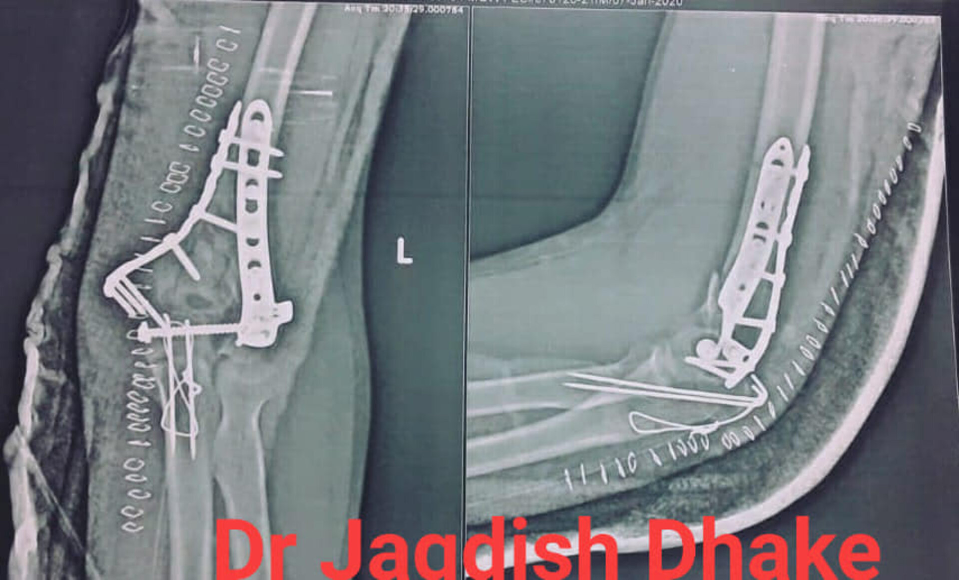 Distal Humerus Comminuted Fracture | Dr. Jagdish Dhake