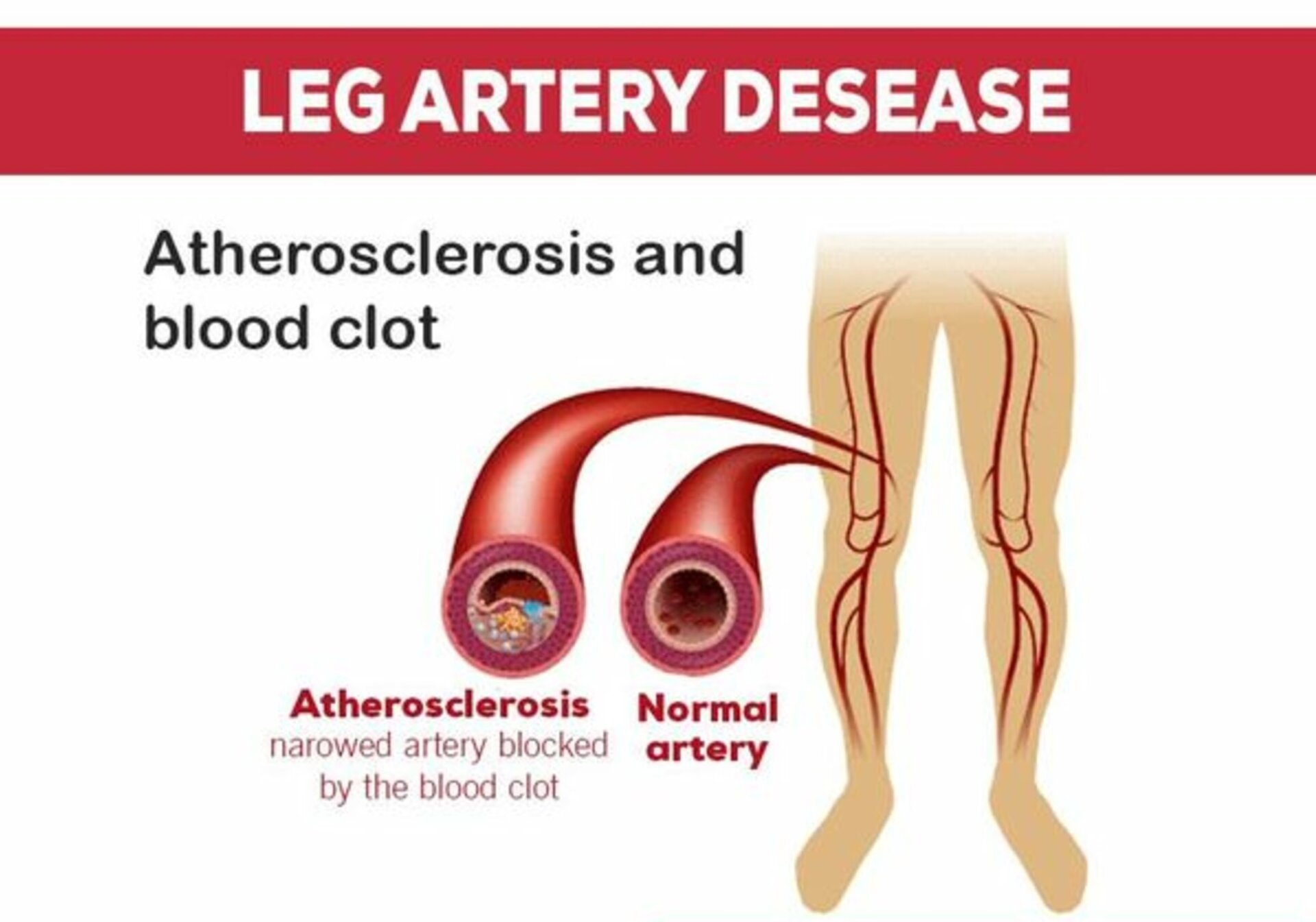 Leg Artery Disease - Dr. Advait Kothurkar