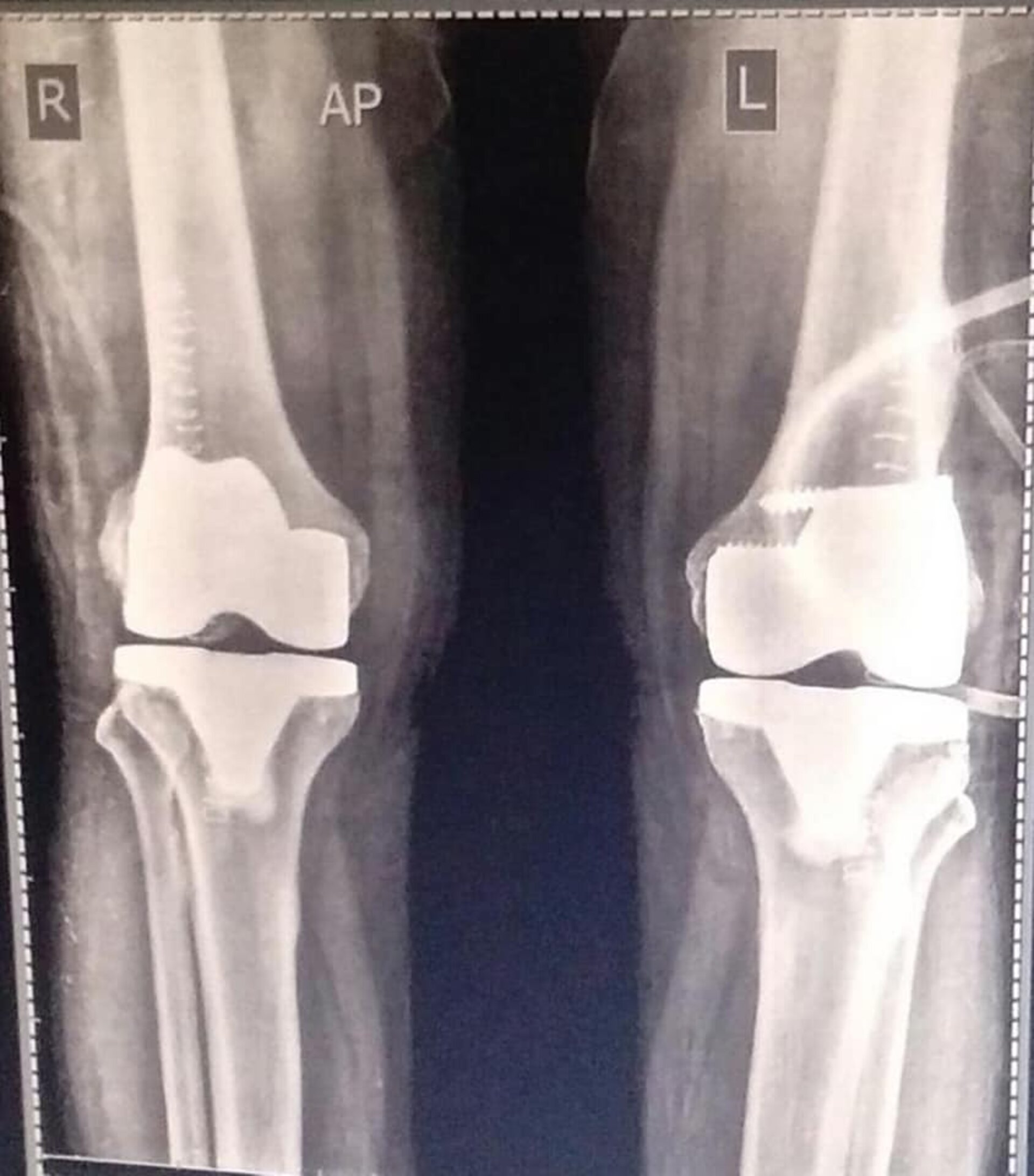 60-year male undergoes Bilateral Total Knee Replacement | Dr. Jagdish Dhake