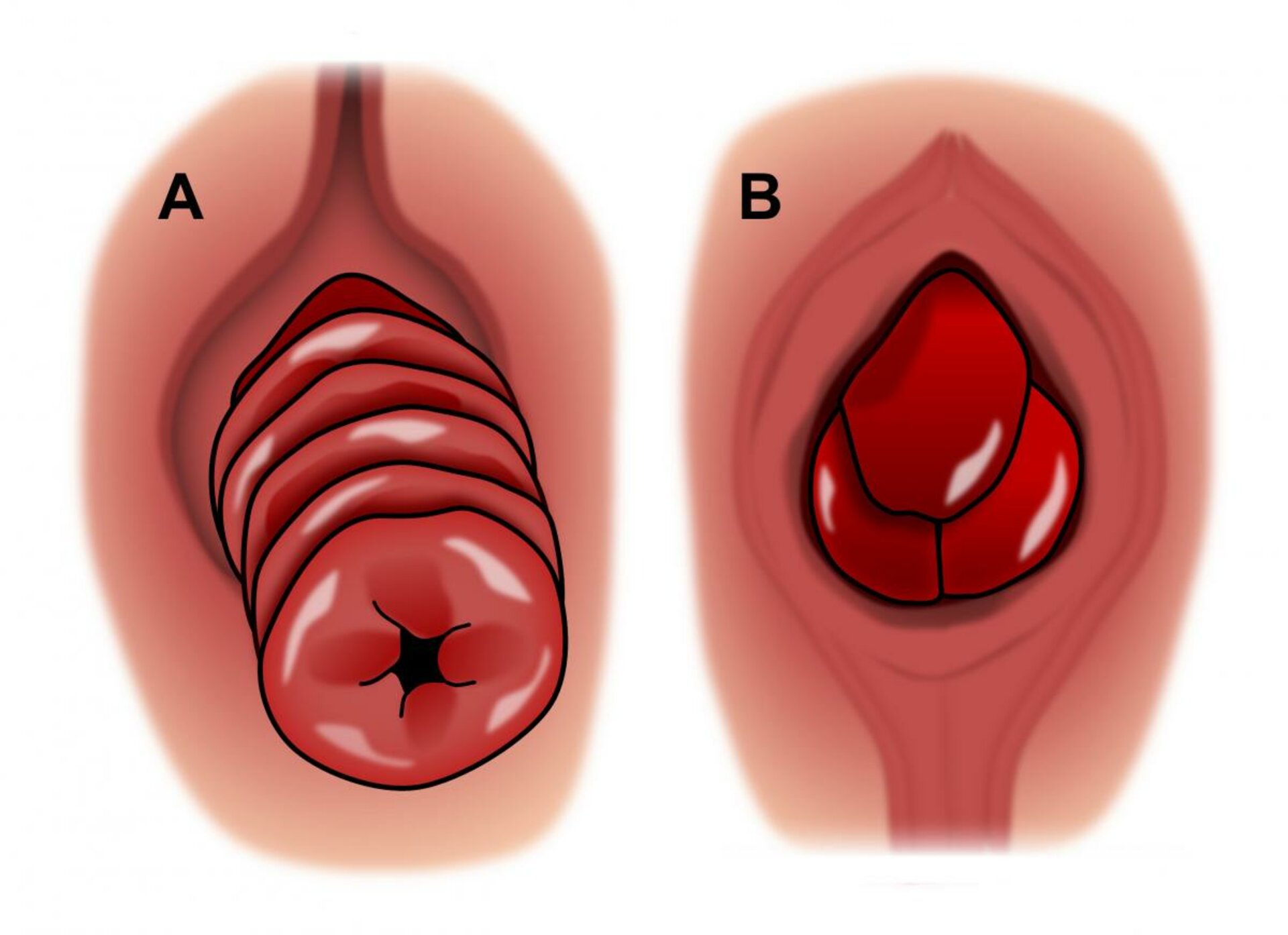 Prolapse Rectal |Dr. Hina Khan